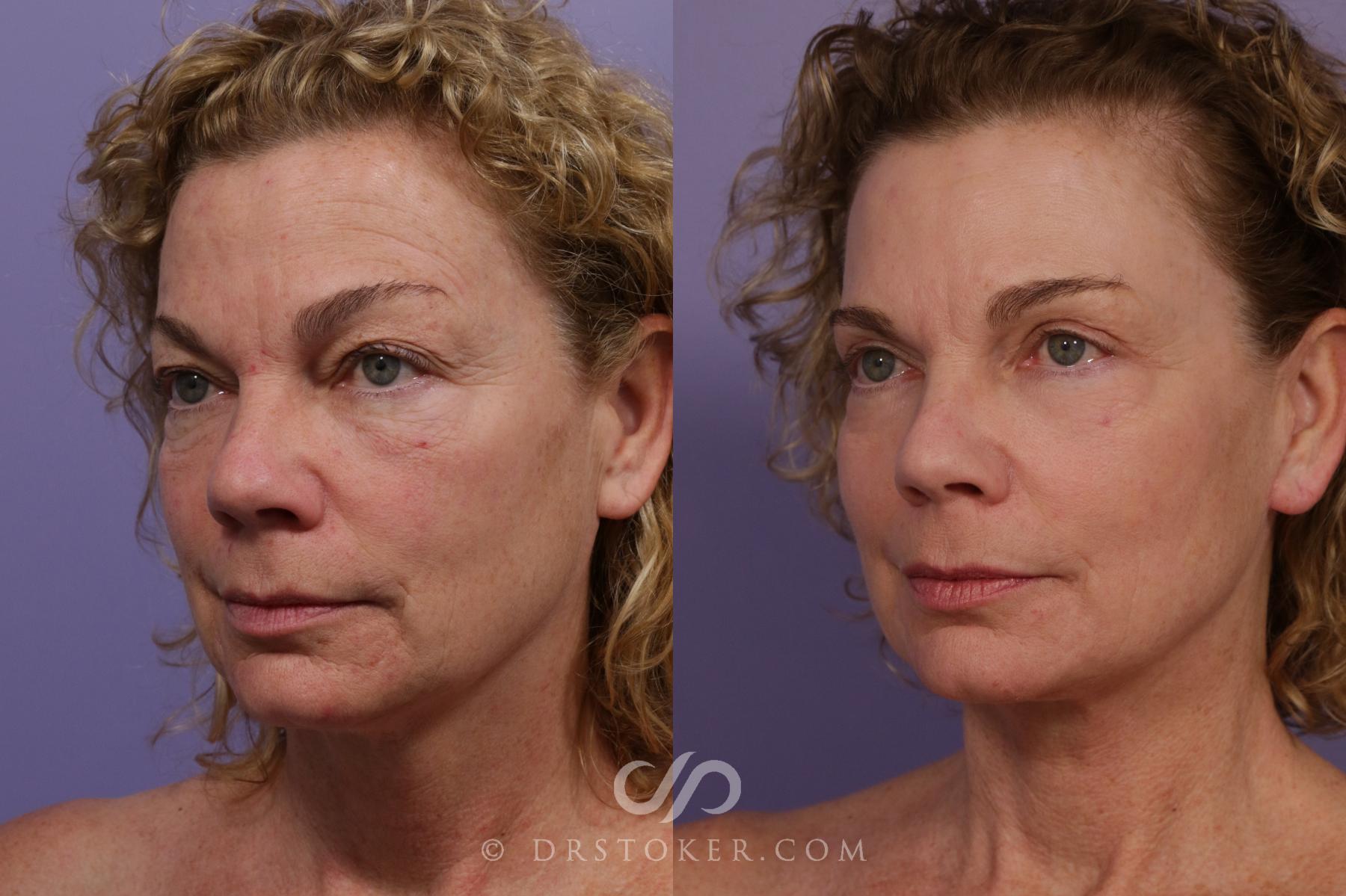 Before & After Facelift - Traceless Facelift Case 1770 Left Oblique View in Los Angeles, CA