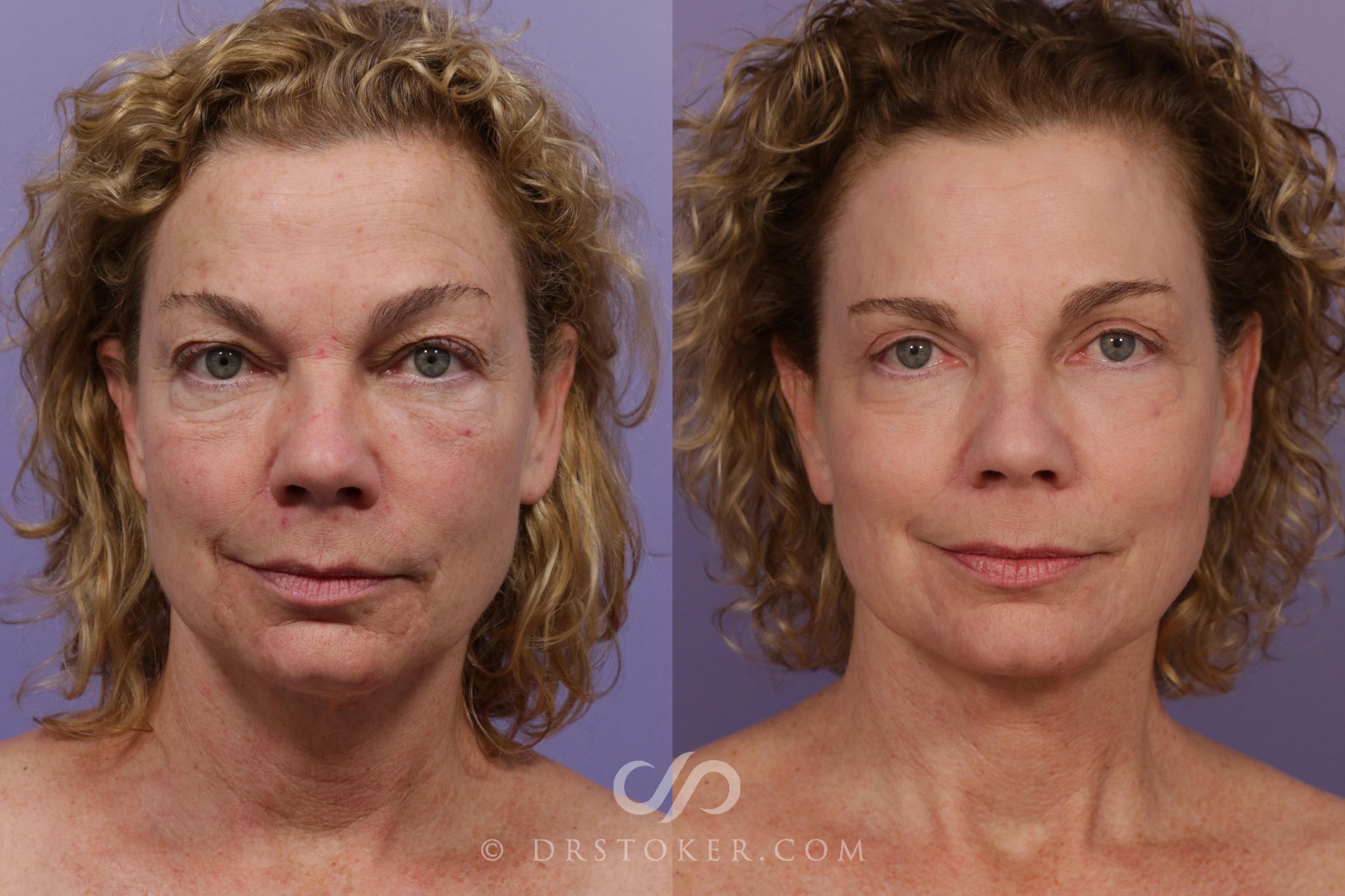 Before & After Facelift - Traceless Facelift Case 1770 View #1 View in Los Angeles, CA