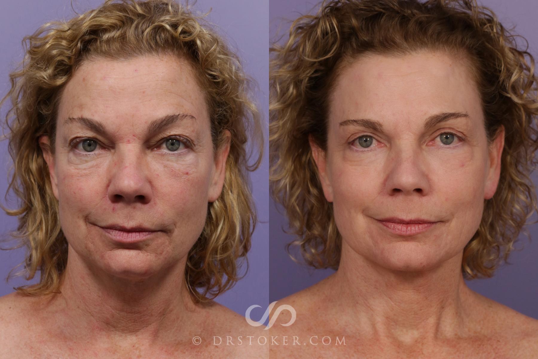 Before & After Facelift - Traceless Facelift Case 1770 View #1 View in Los Angeles, CA
