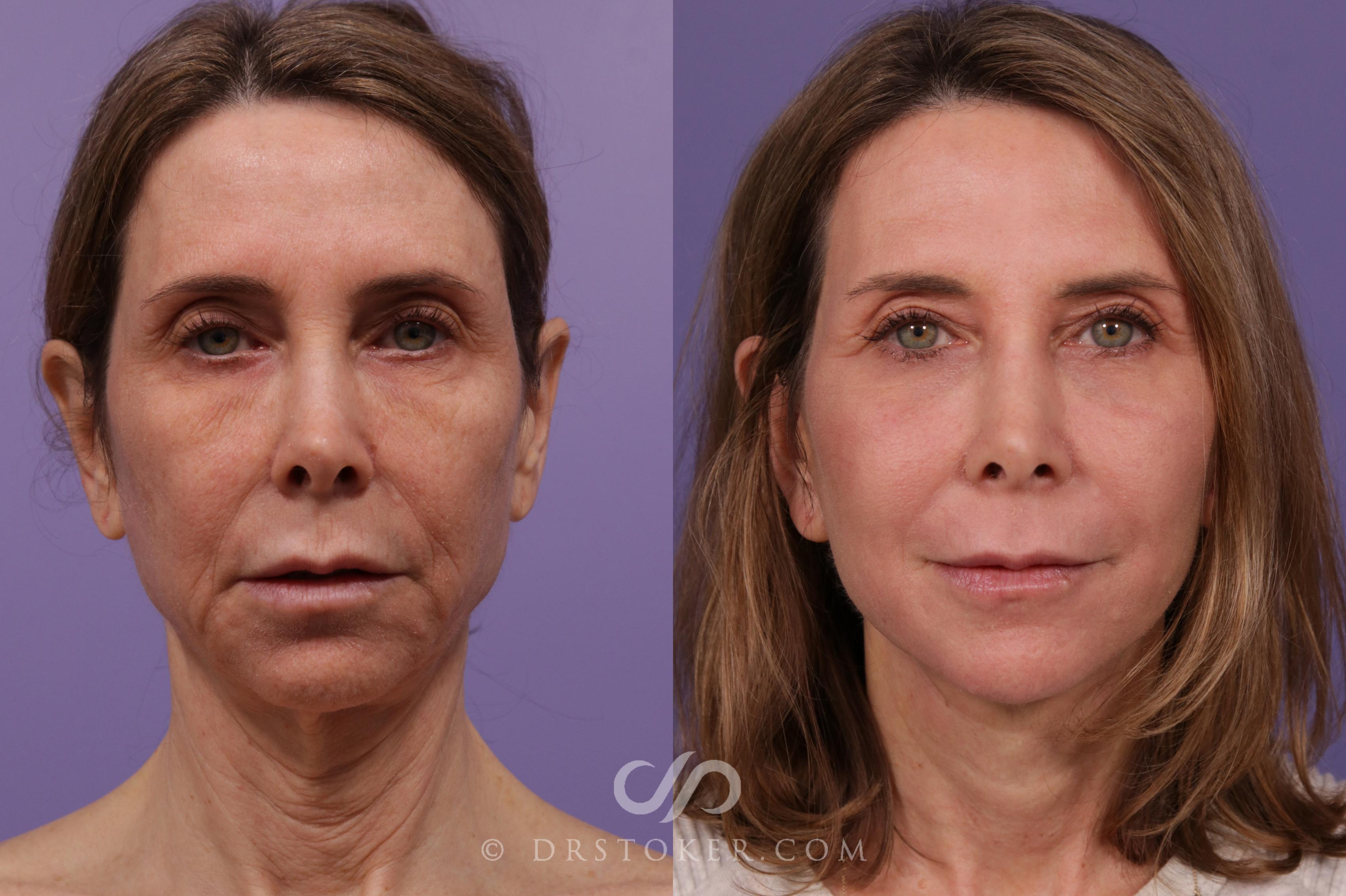 Before & After Facelift - Traceless Facelift Case 1771 View #1 View in Los Angeles, CA