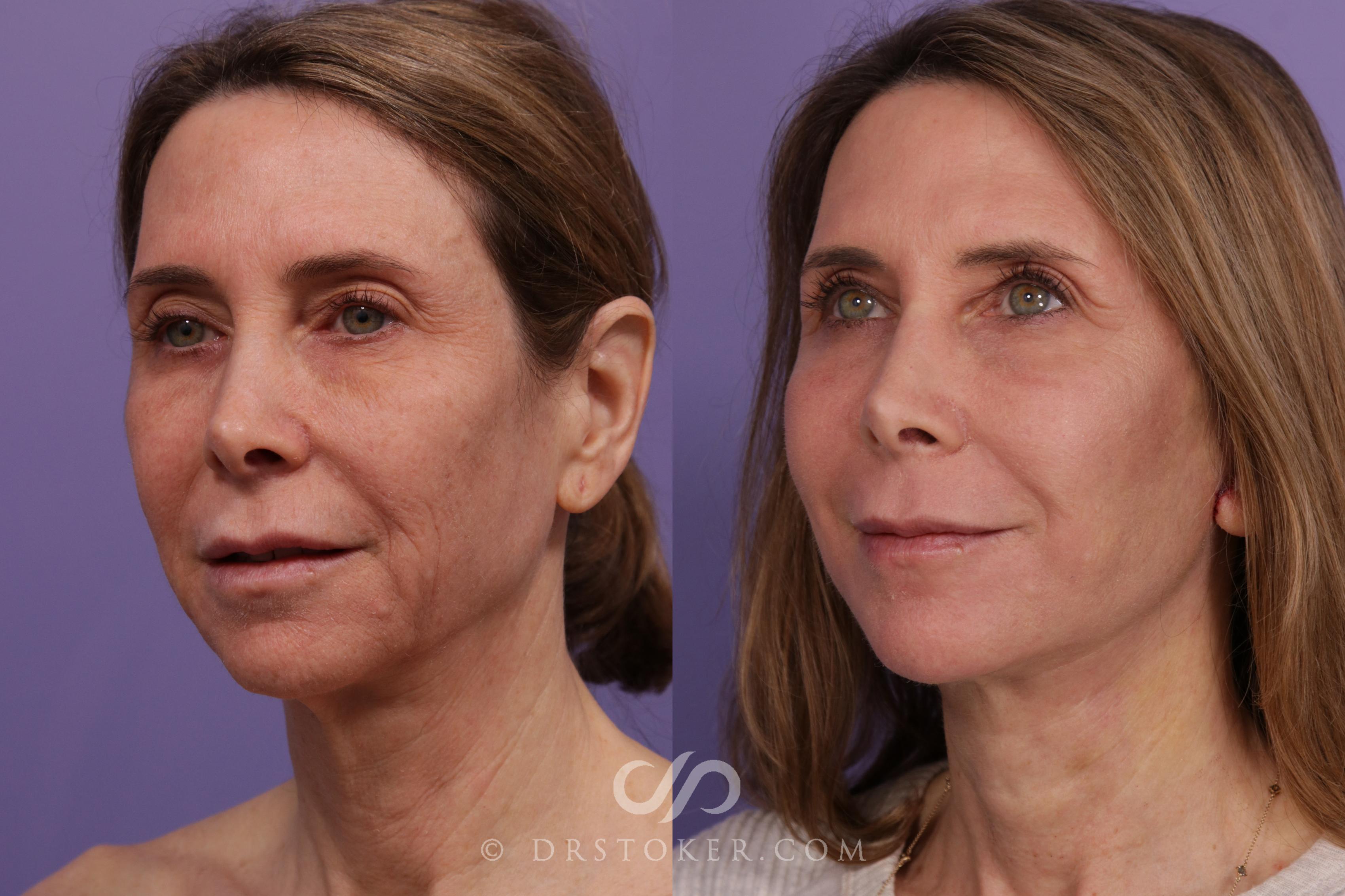 Before & After Laser Skin Resurfacing  Case 1771 View #2 View in Los Angeles, CA