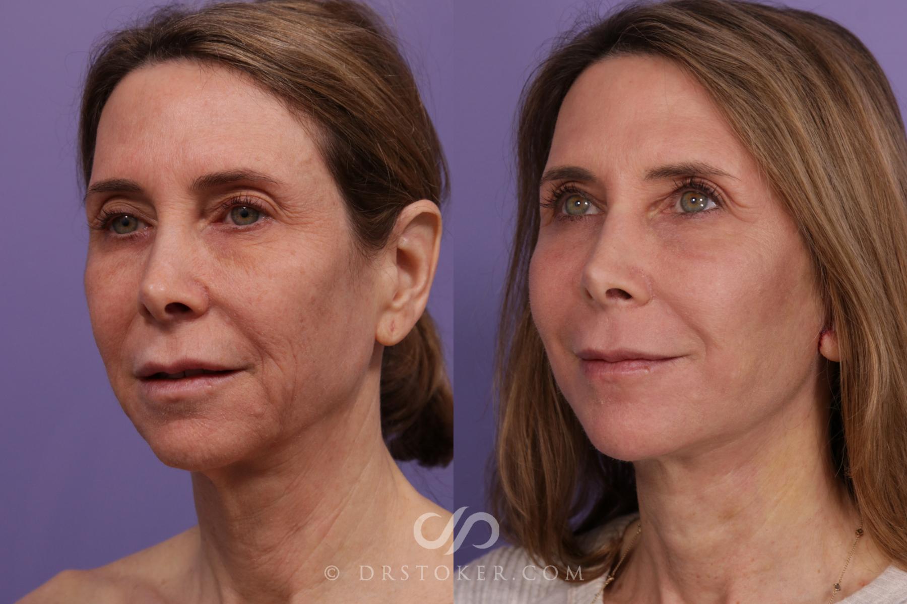 Before & After Facelift - Traceless Facelift Case 1771 View #2 View in Los Angeles, CA