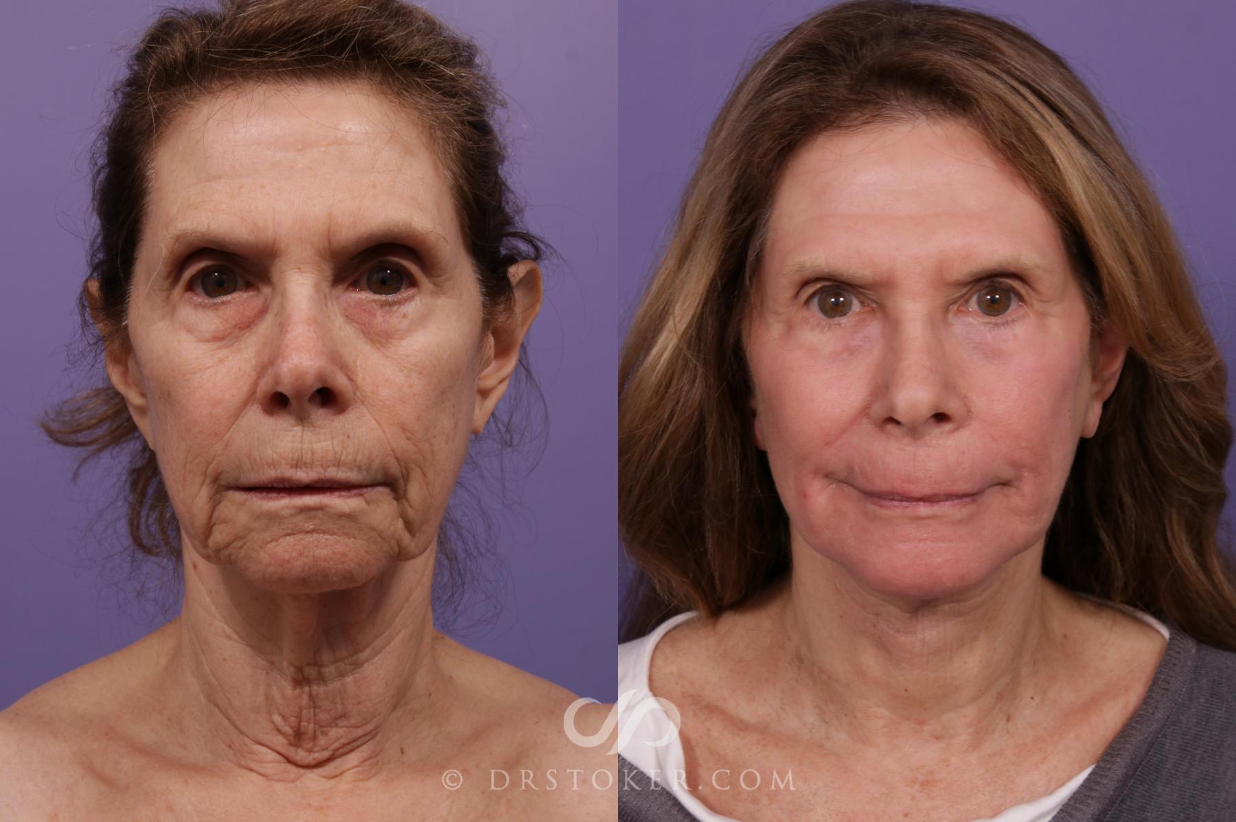 Before & After Facelift - Traceless Facelift Case 1772 View #1 View in Los Angeles, CA