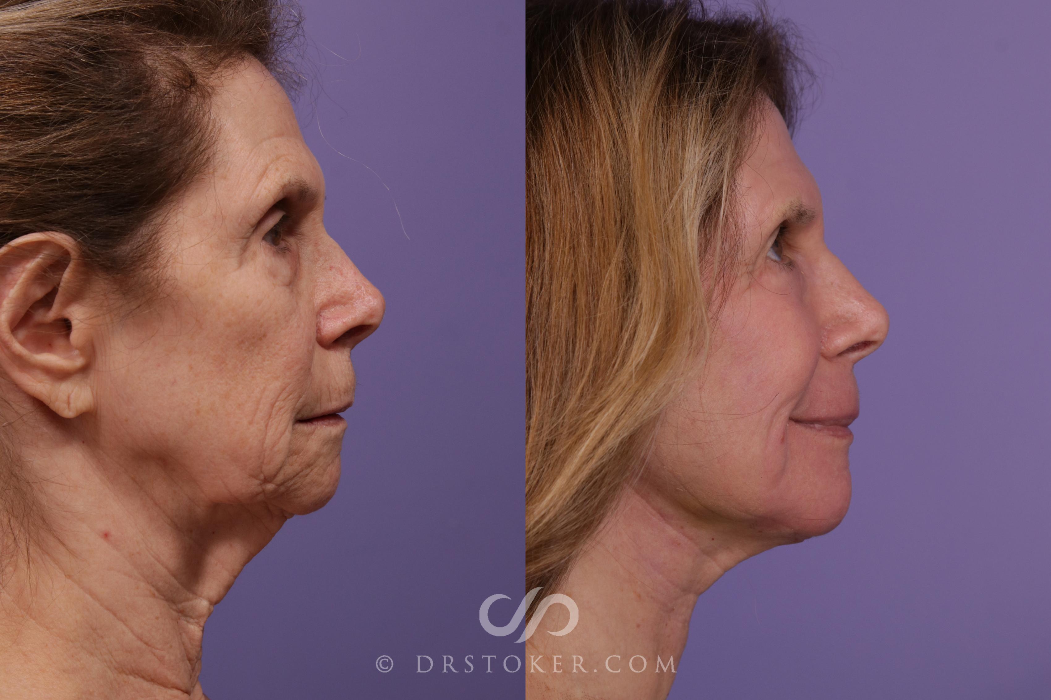 Before & After Facelift - Traceless Facelift Case 1772 View #2 View in Los Angeles, CA