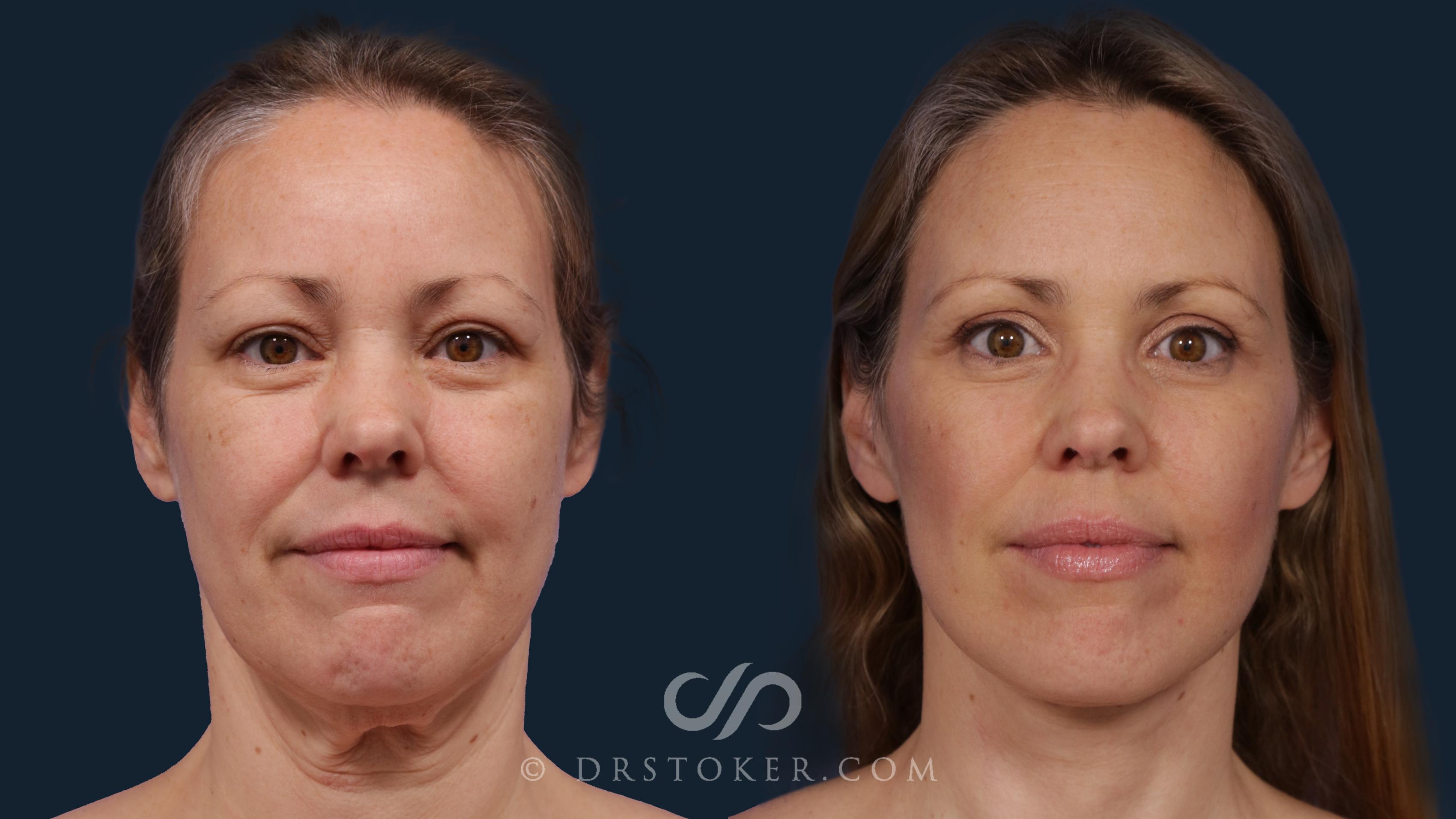 Before & After Facelift - Traceless Facelift Case 1788 Front View in Los Angeles, CA