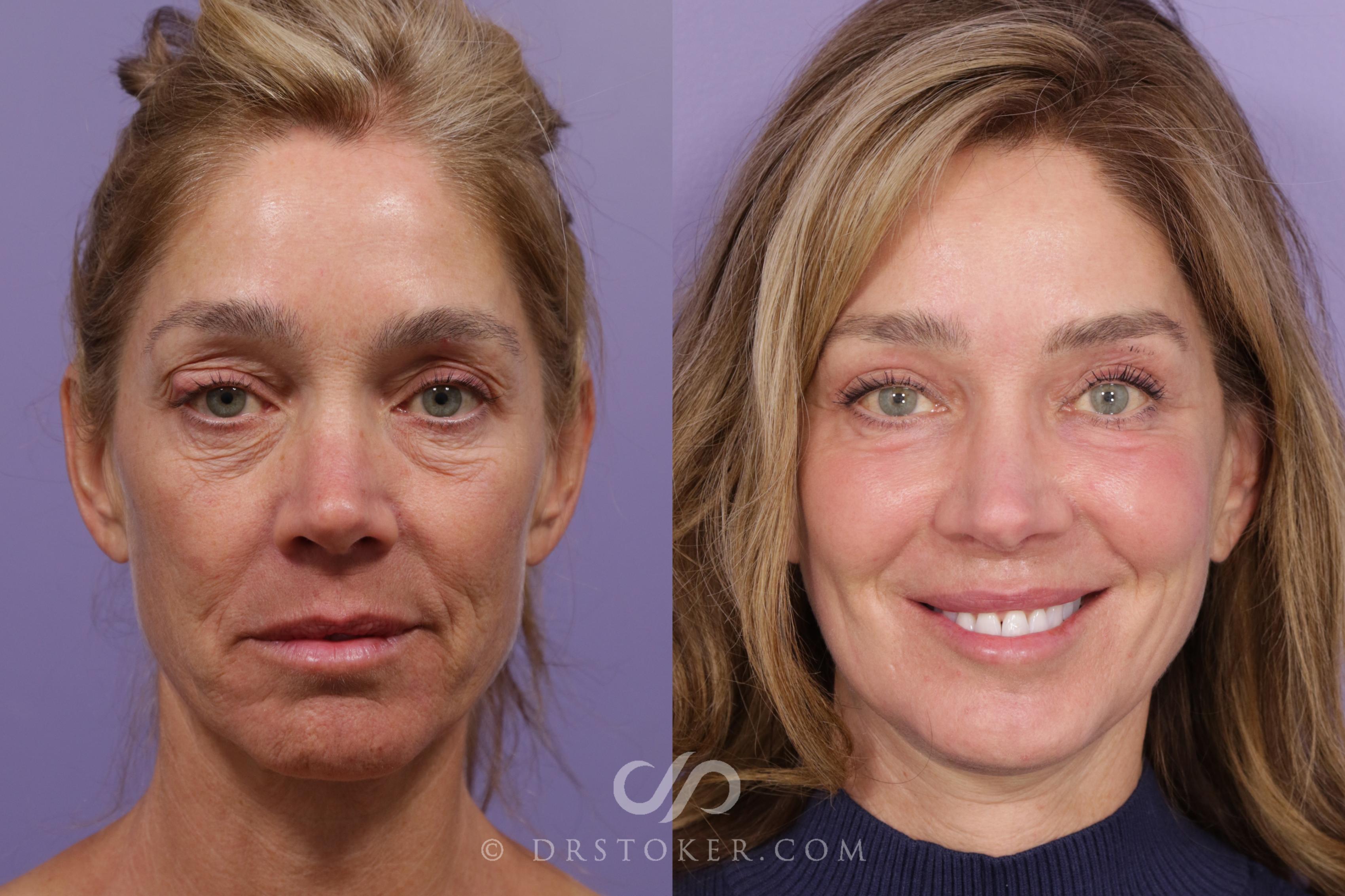 Before & After Deep Plane Facelift/Neck Lift - Traceless Deep Plane Facelift Case 1849 Front View in Los Angeles, CA