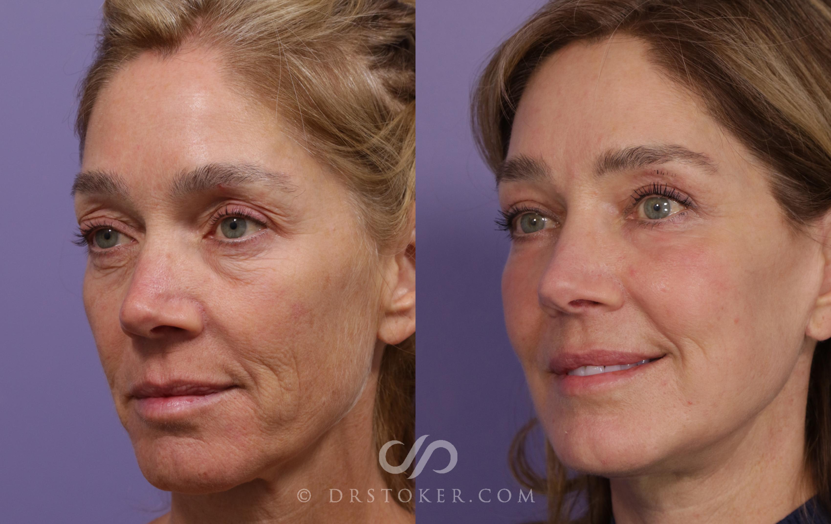 Before & After Facelift - Traceless Facelift Case 1849 Left Oblique View in Los Angeles, CA