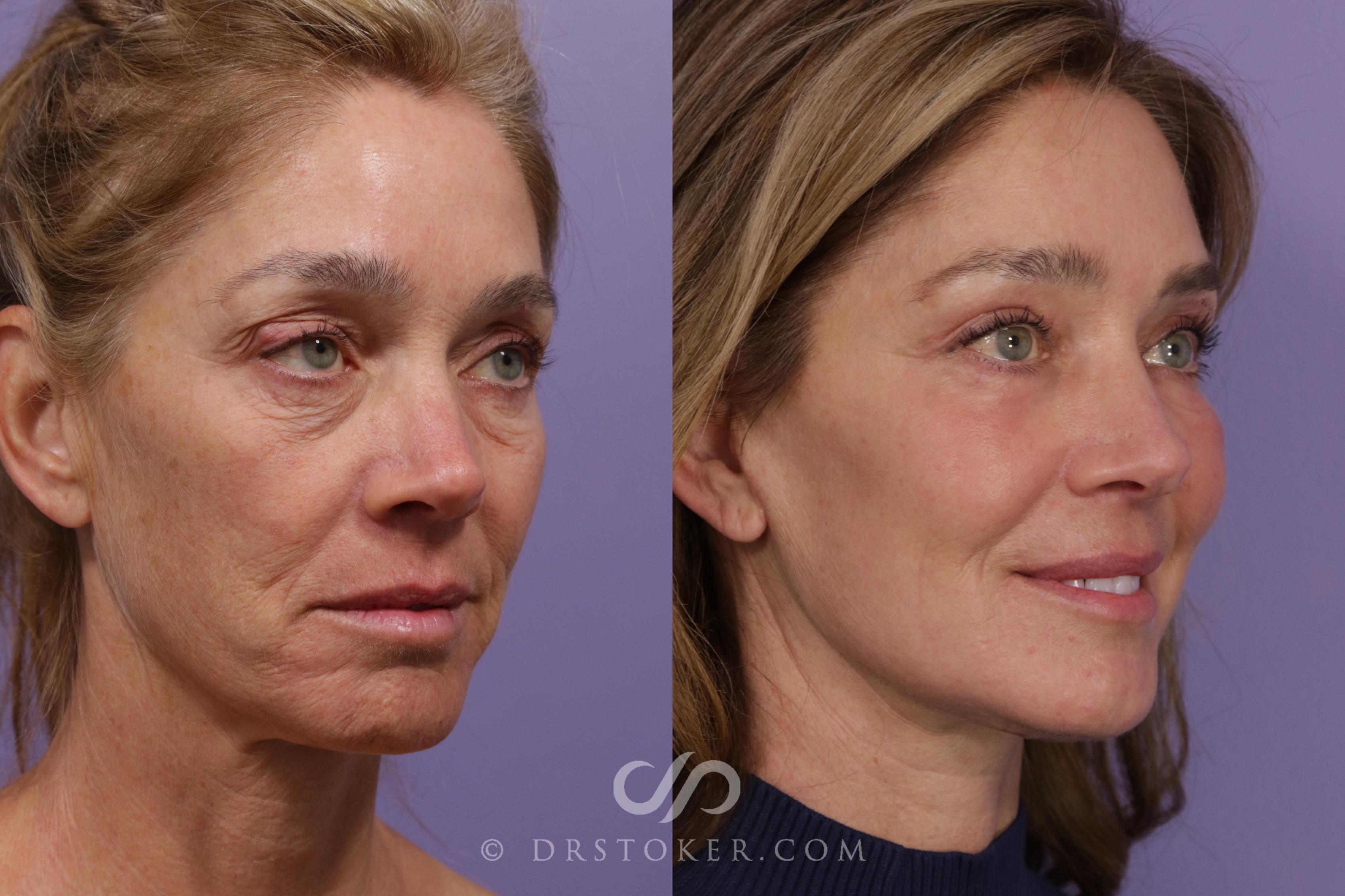 Before & After Facelift - Traceless Facelift Case 1849 Right Oblique View in Marina del Rey, CA