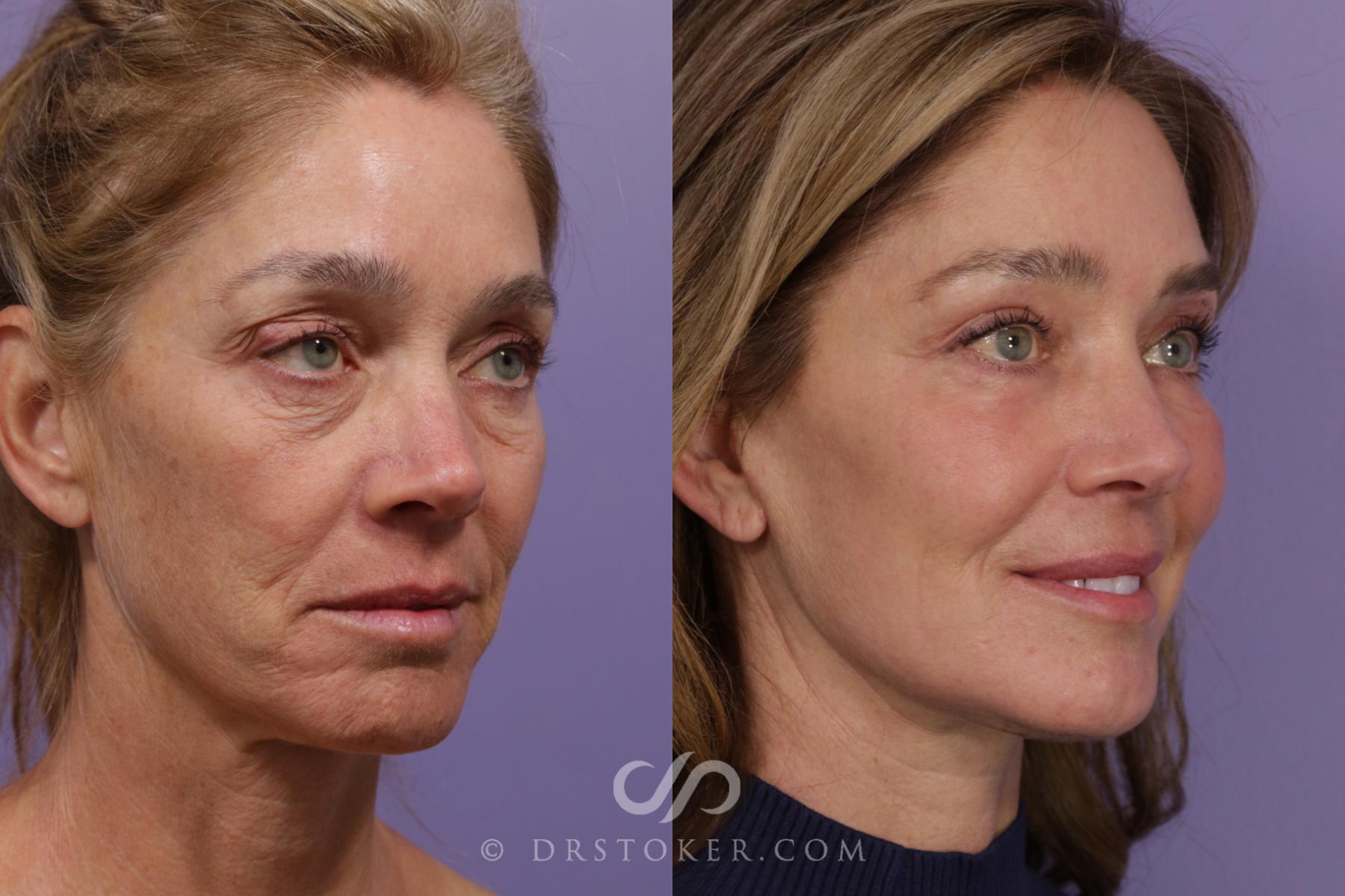 Before & After Facelift/Neck Lift (Deep Plane/Traceless) Case 1849 Right Oblique View in Los Angeles, CA