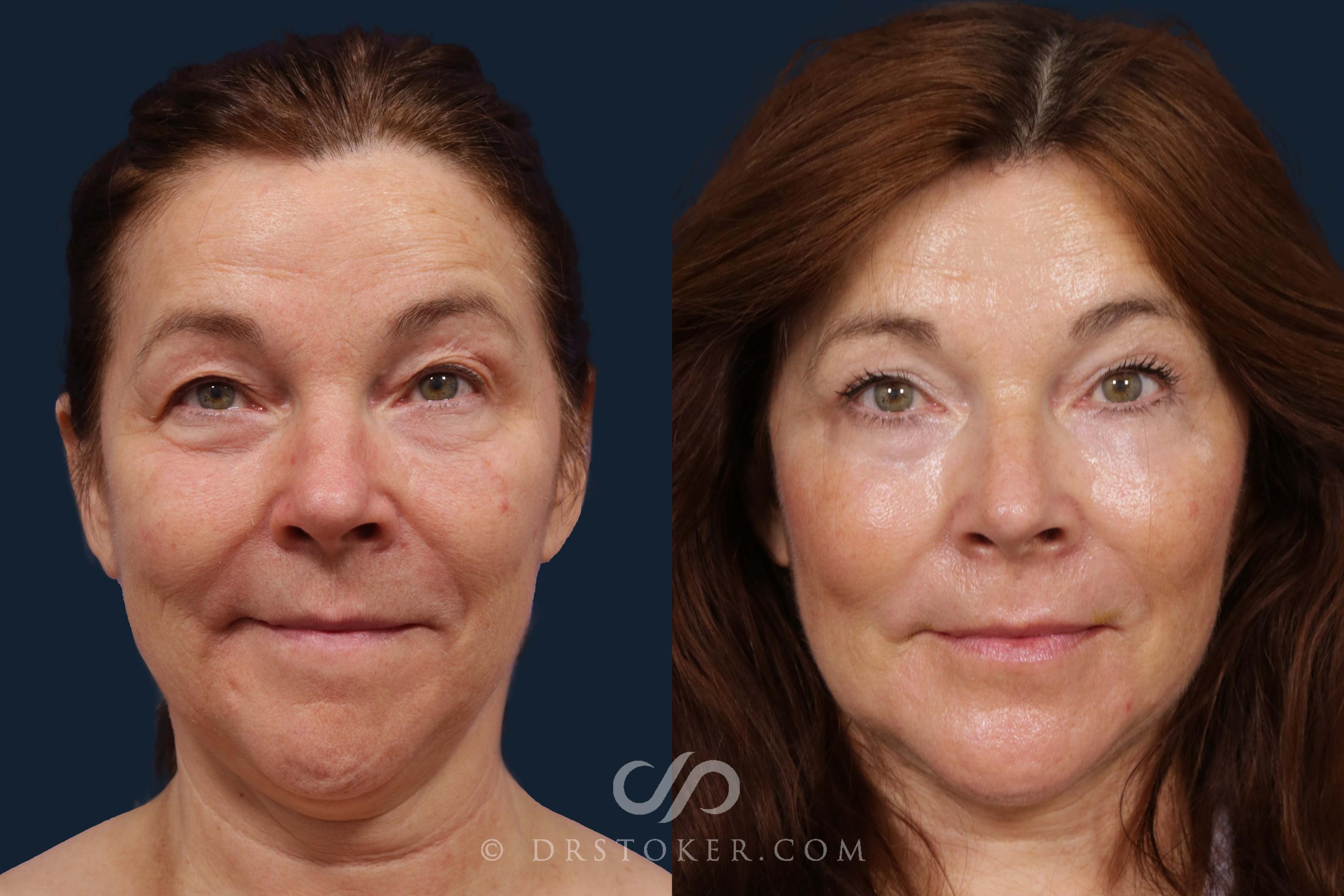 Before & After Facelift - Traceless Facelift Case 1902 Front View in Los Angeles, CA
