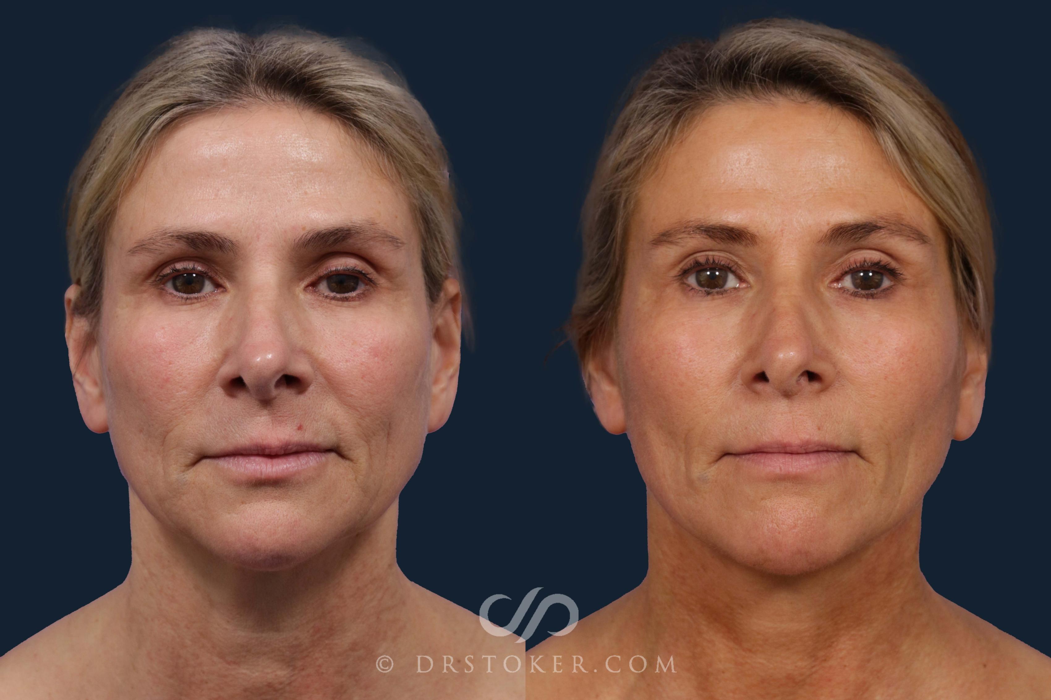 Before & After Facelift - Traceless Facelift Case 1920 Front View in Los Angeles, CA