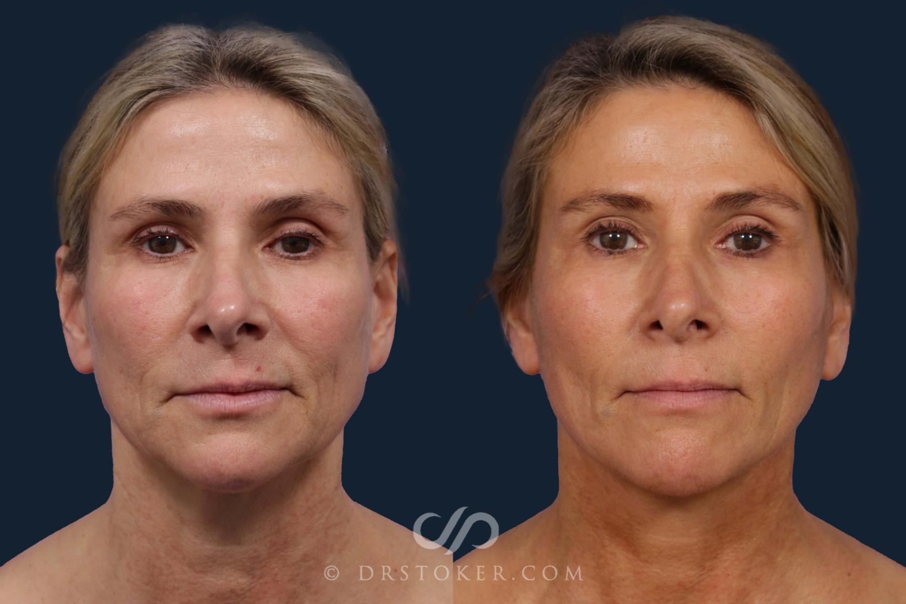 Before & After Facelift - Traceless Facelift Case 1920 Front View in Los Angeles, CA