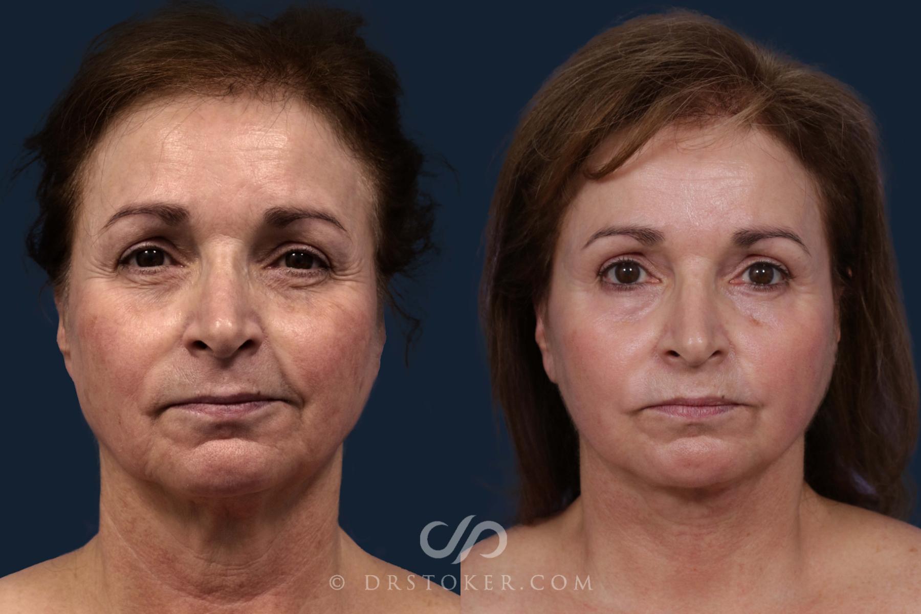 Before & After Facelift - Traceless Facelift Case 1921 Front View in Los Angeles, CA