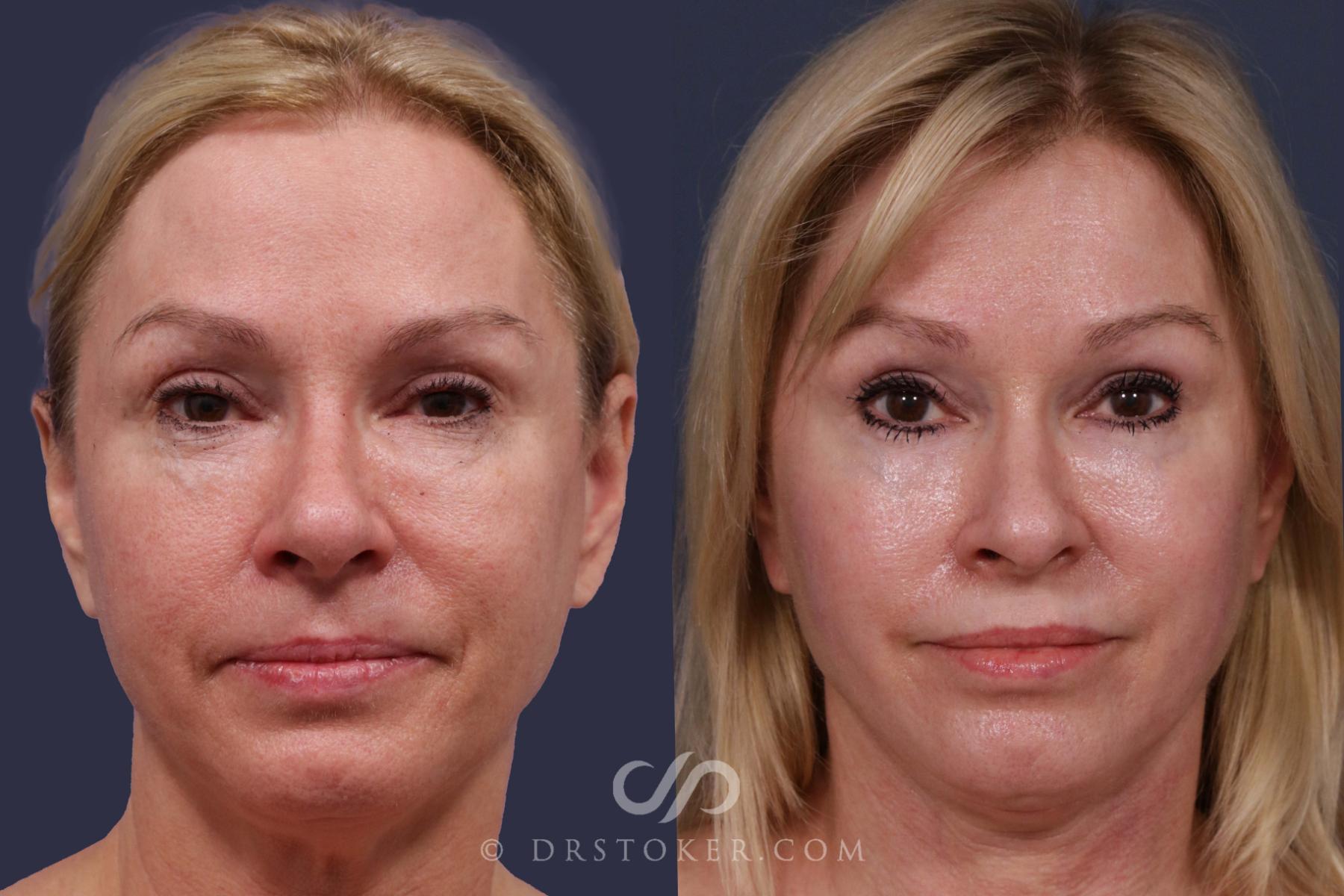 Before & After Facelift - Traceless Facelift Case 2017 Front View in Los Angeles, CA