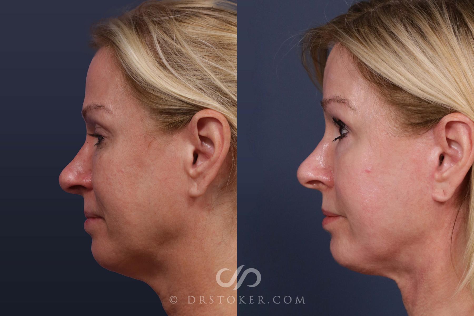 Before & After Laser Skin Resurfacing (Mouth) Case 2017 Left Side View in Los Angeles, CA