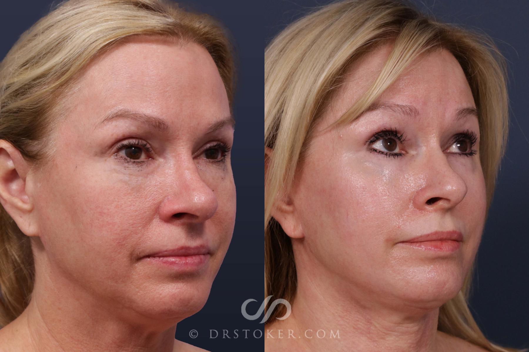 Before & After Facelift - Traceless Facelift Case 2017 Right Oblique View in Los Angeles, CA