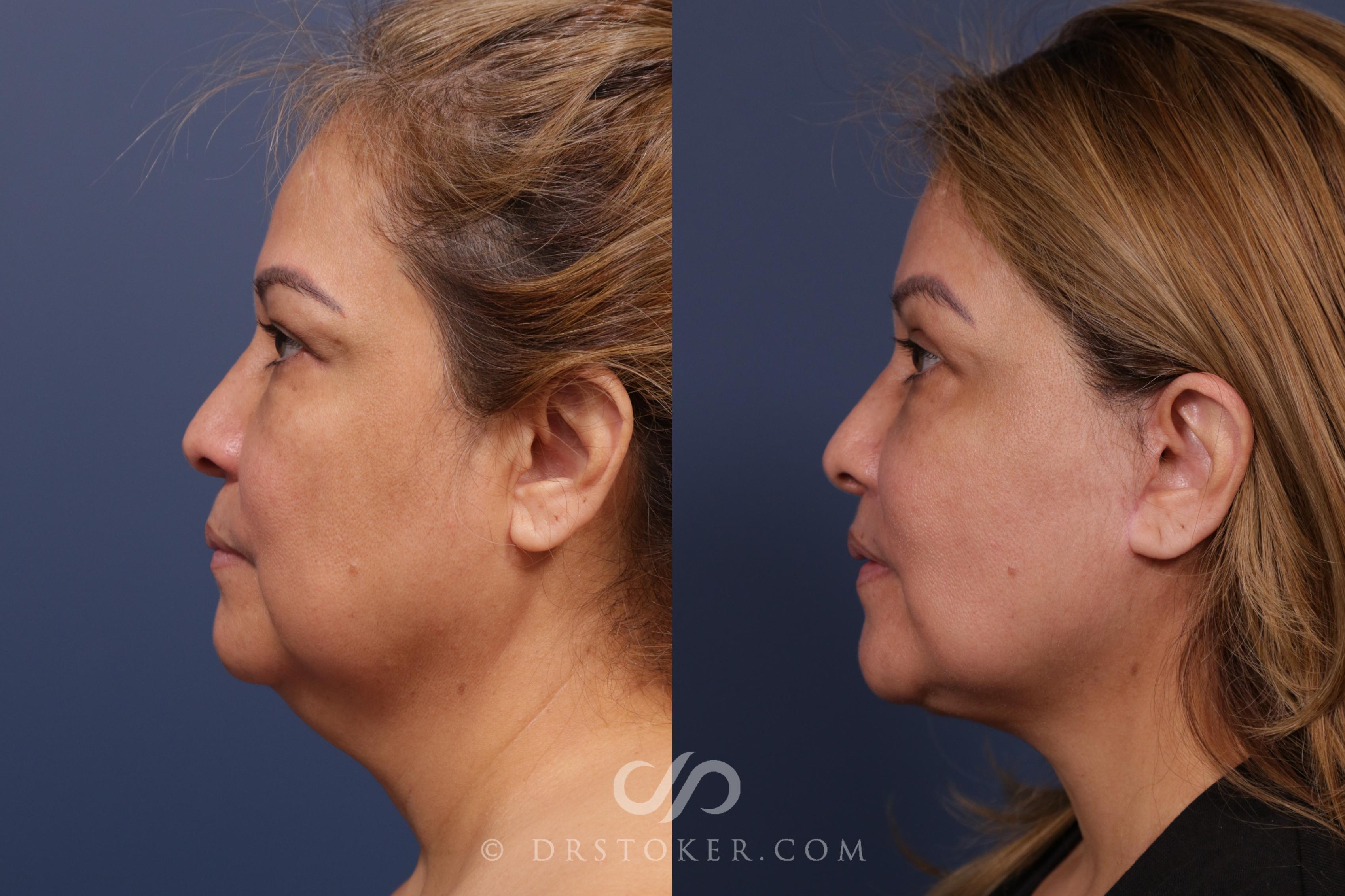 Before & After Facelift - Traceless Facelift Case 2029 Left Side View in Los Angeles, CA