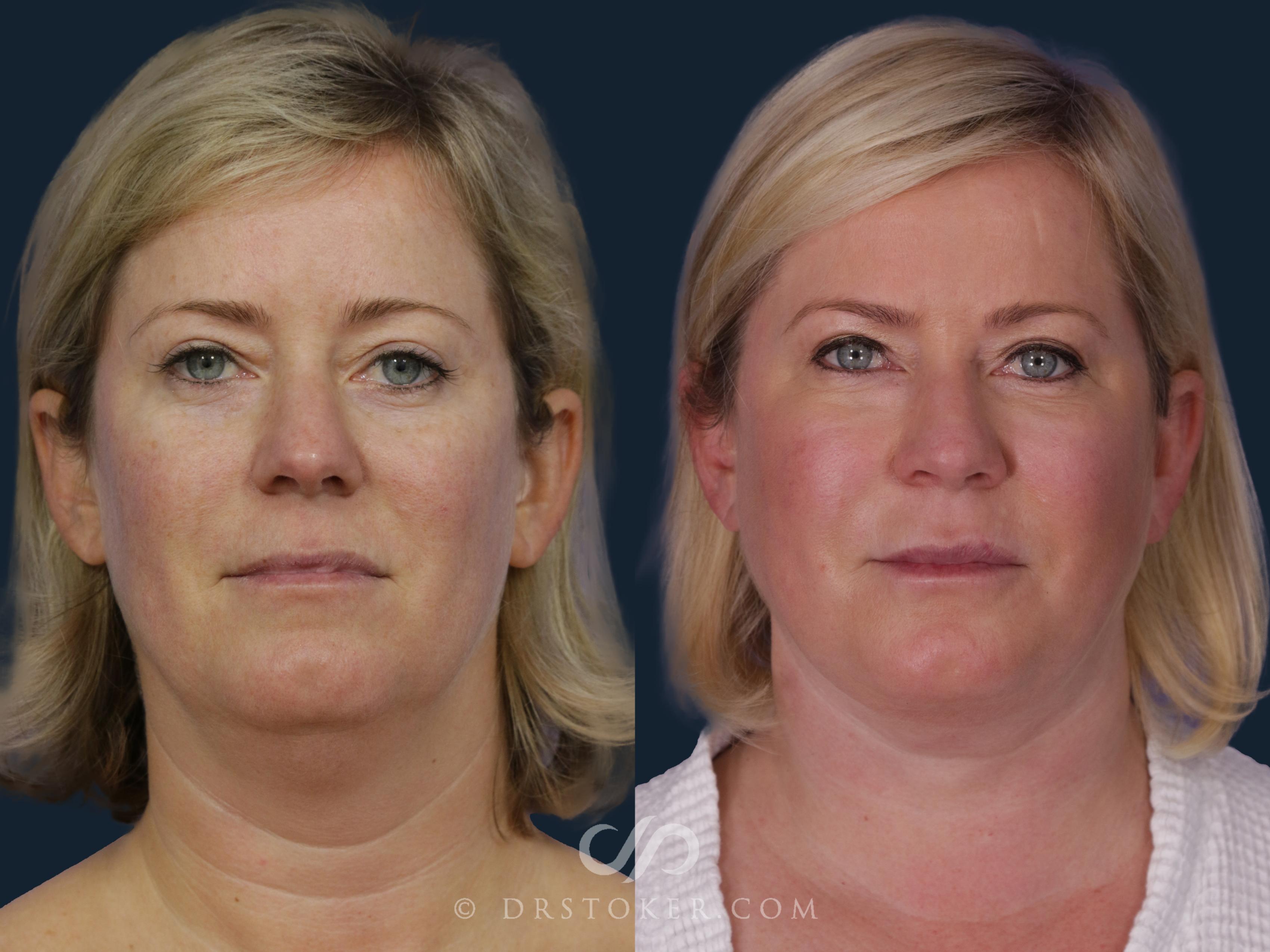 Before & After Facelift - Traceless Facelift Case 2058 Front View in Los Angeles, CA