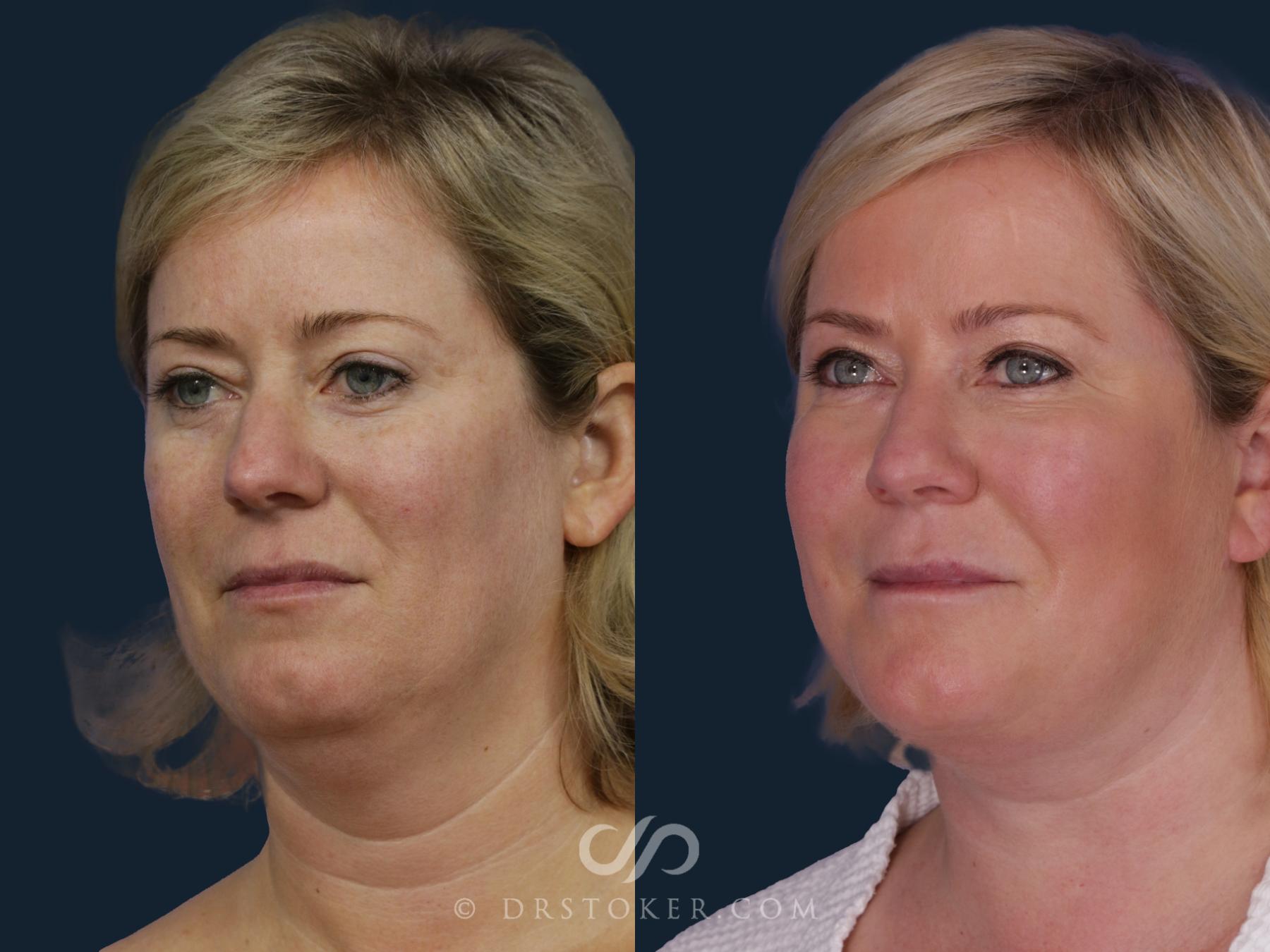 Before & After Facelift - Traceless Facelift Case 2058 Left Oblique View in Los Angeles, CA