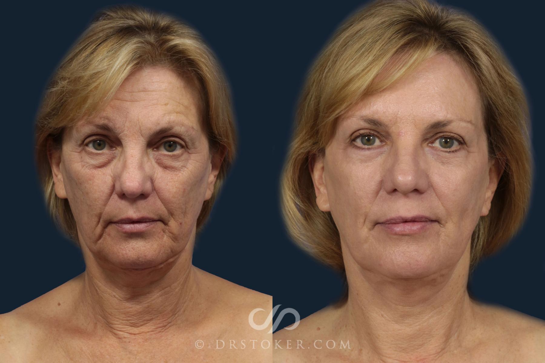 Before & After Facelift - Traceless Facelift Case 2085 Front View in Los Angeles, CA