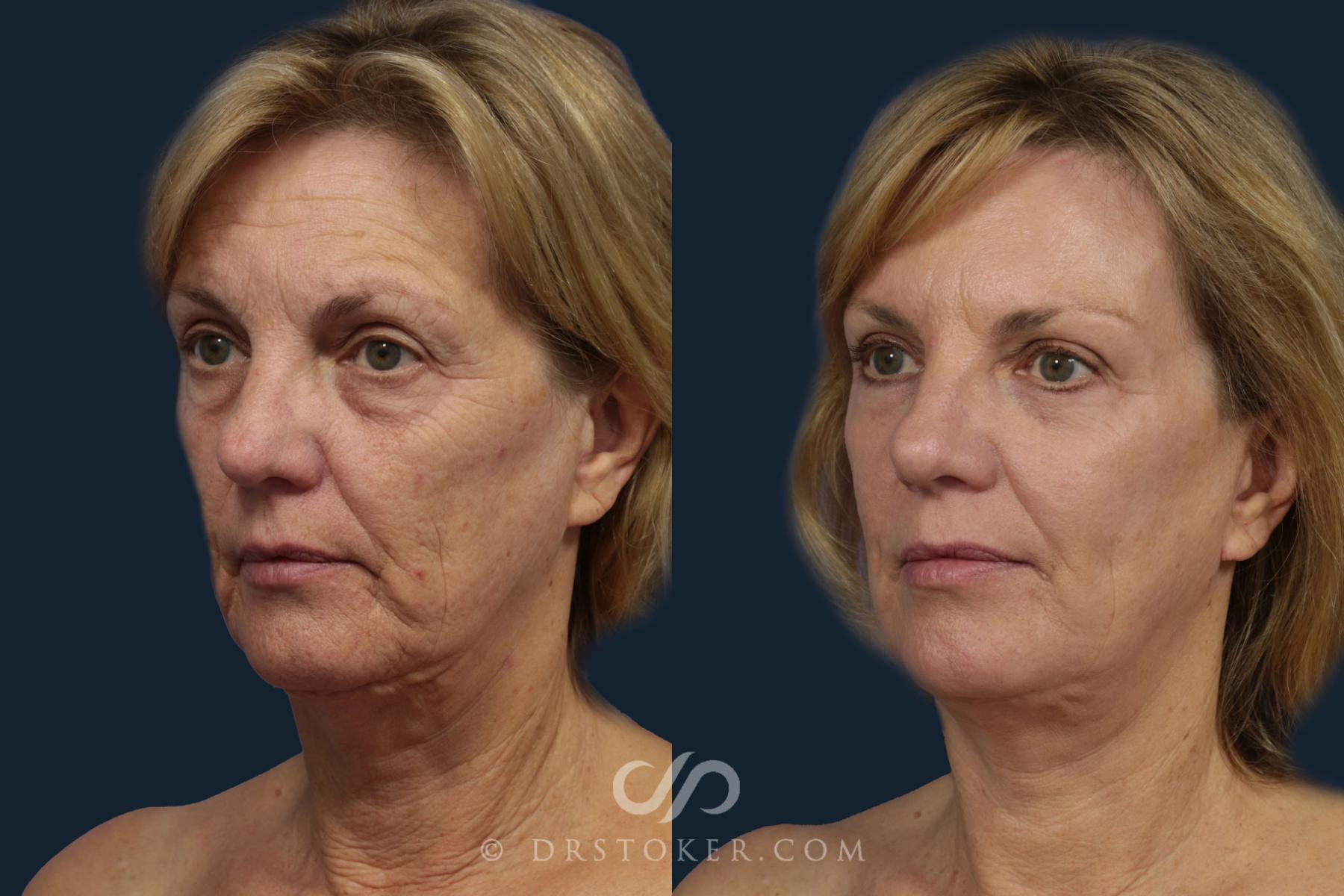 Before & After Facelift - Traceless Facelift Case 2085 Left Oblique View in Los Angeles, CA