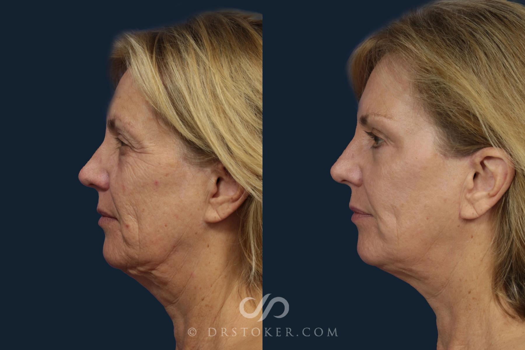 Before & After Facelift - Traceless Facelift Case 2085 Left Side View in Los Angeles, CA