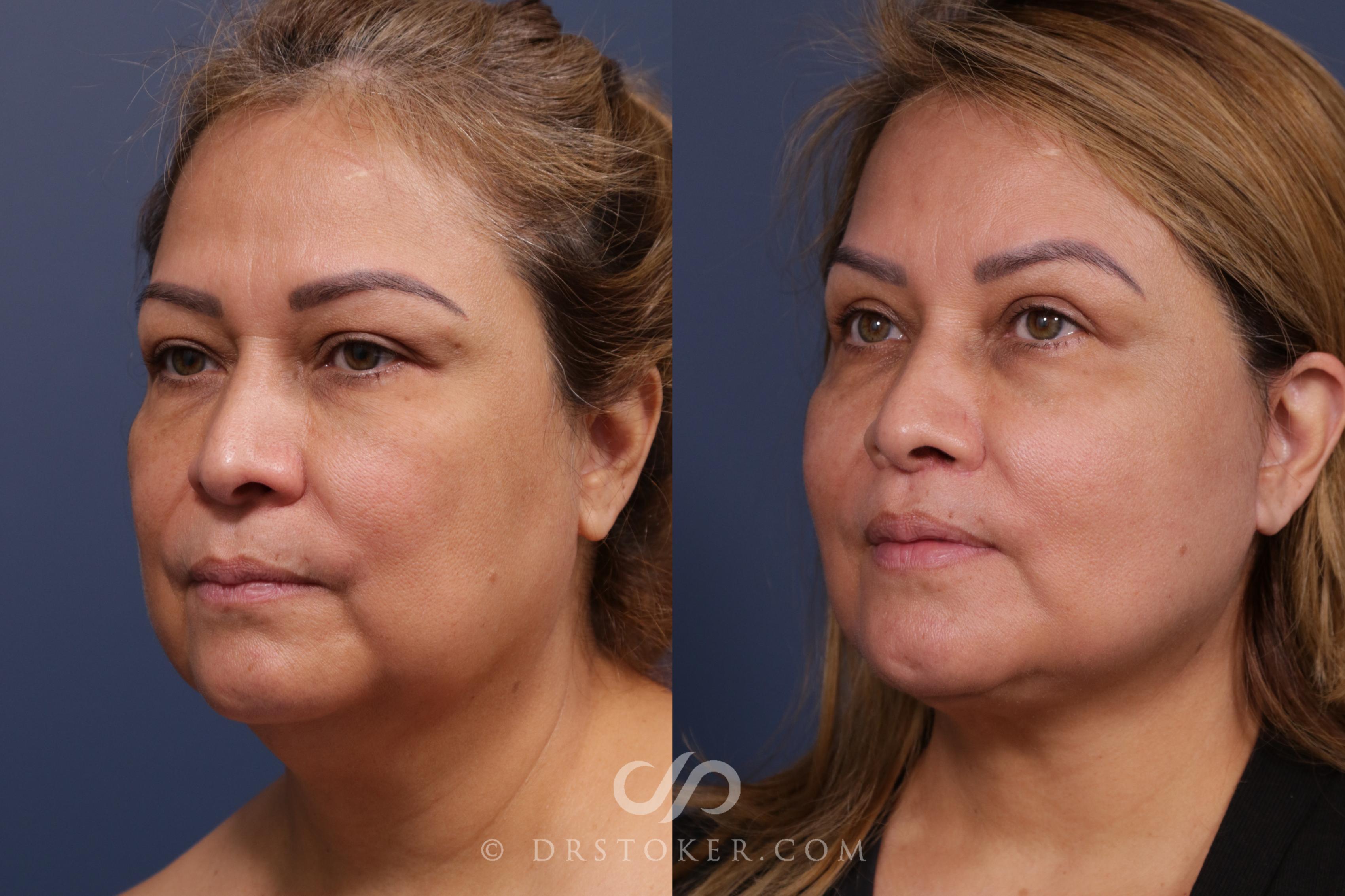 Before & After Facelift - Traceless Facelift Case 2117 Left Oblique View in Los Angeles, CA