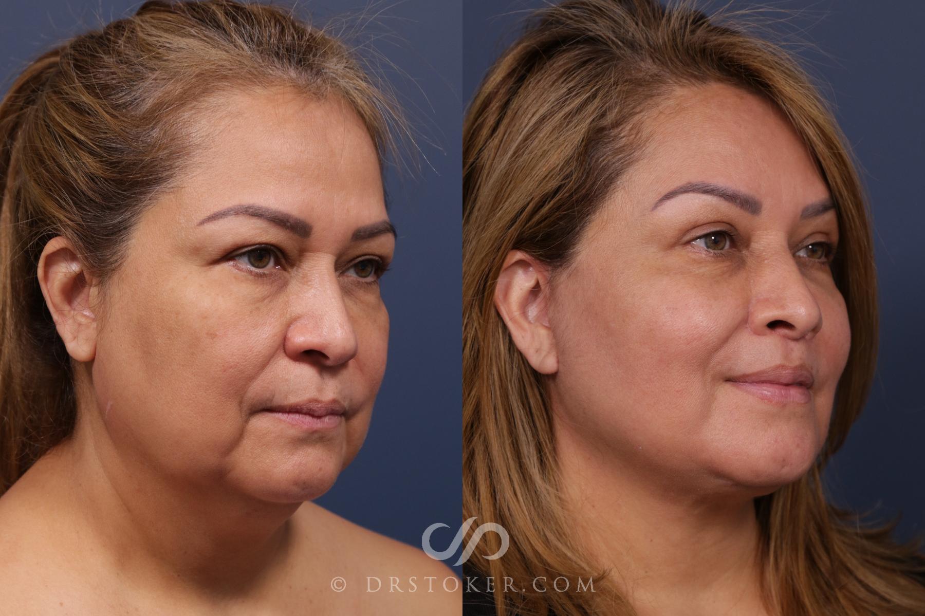 Before & After Facelift - Traceless Facelift Case 2117 Right Oblique View in Los Angeles, CA