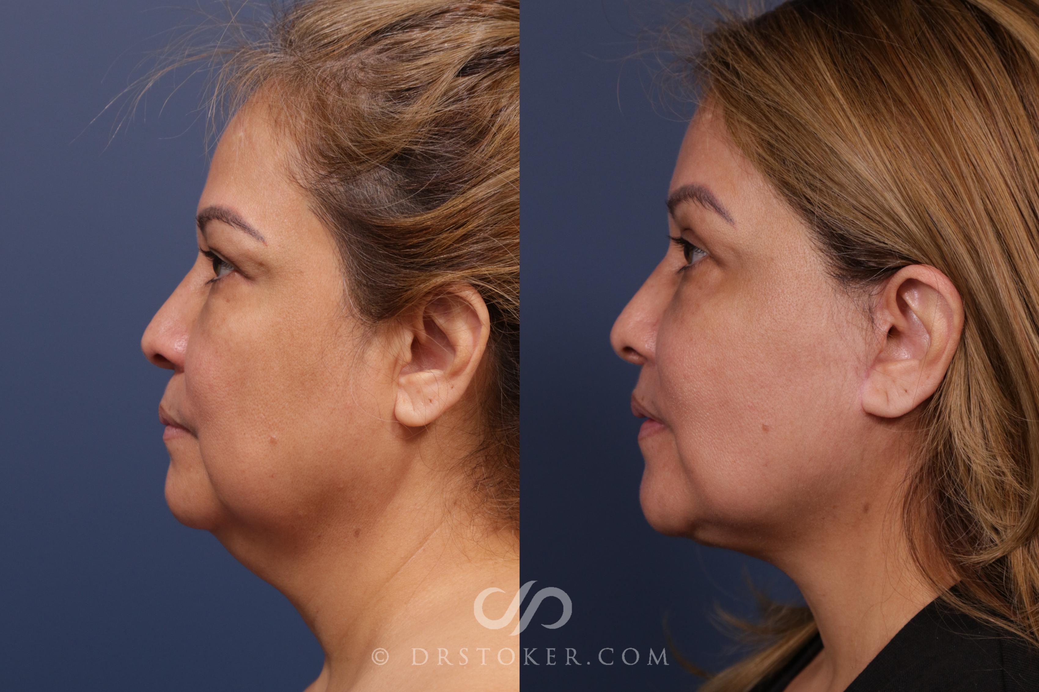 Before & After Facelift Incisions (Hidden Scars) - Traceless Face and Neck Lift Case 2118 Left Side View in Los Angeles, CA