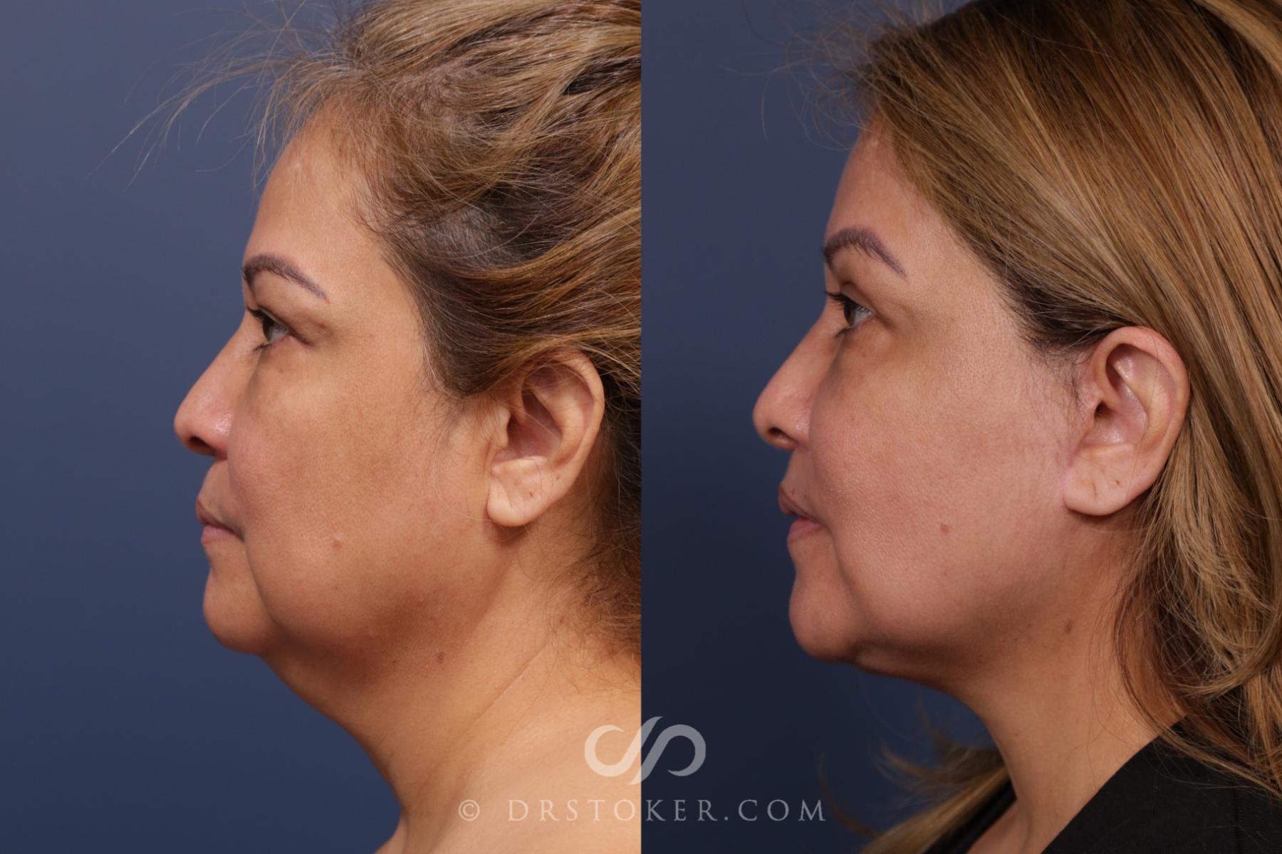 Before & After Facelift - Traceless Facelift Case 2118 Left Side View in Los Angeles, CA