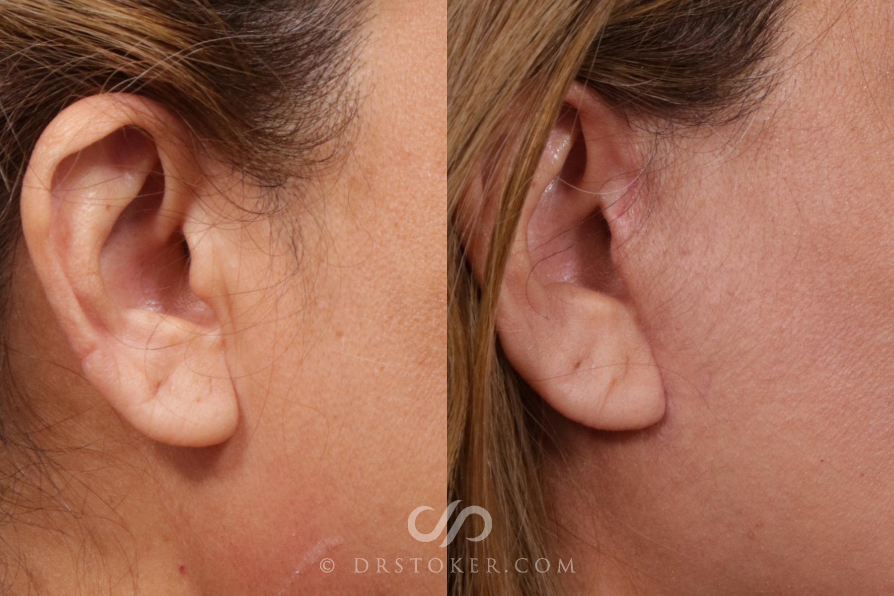 Before & After Facelift Incisions (Hidden Scars)  Case 2118 Right Side View in Los Angeles, CA