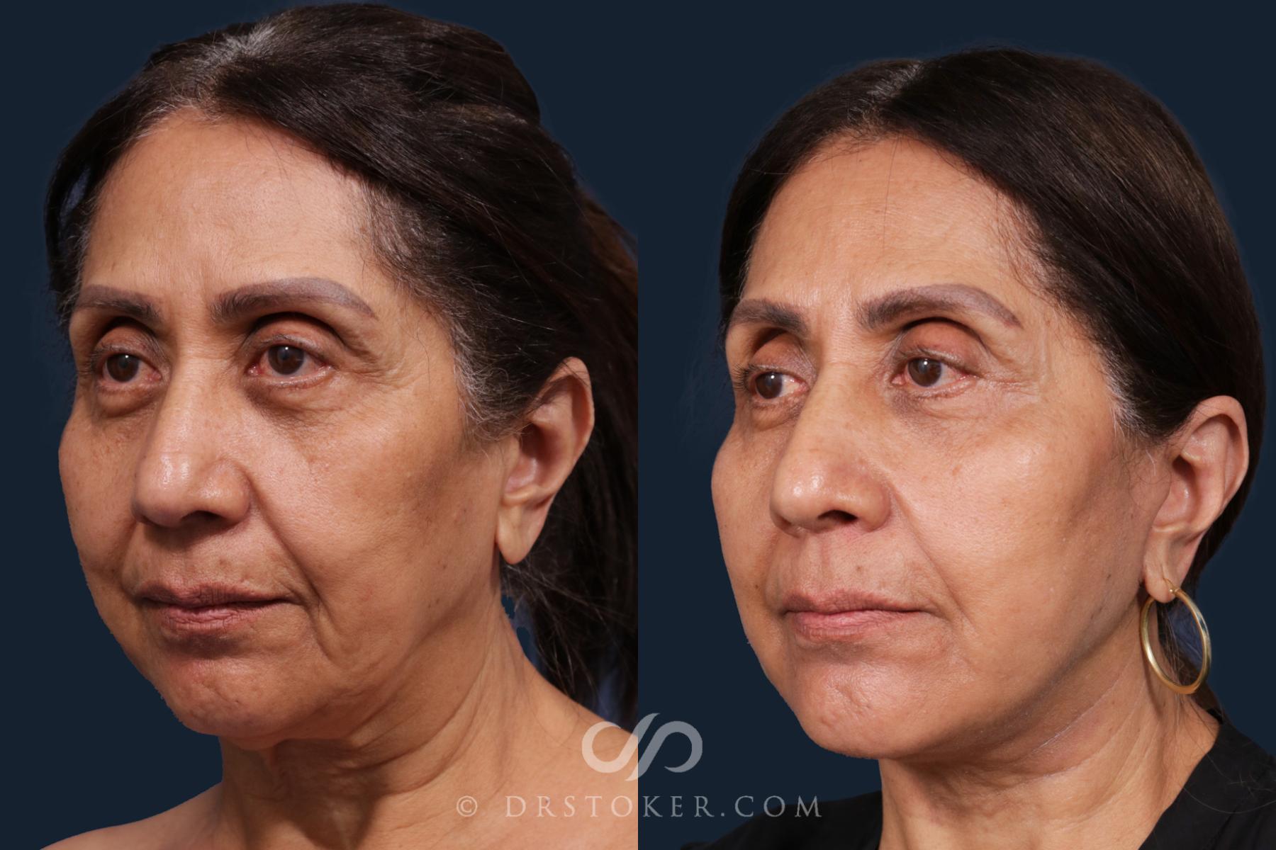 Before & After Facelift - Traceless Facelift Case 2146 Left Oblique View in Los Angeles, CA