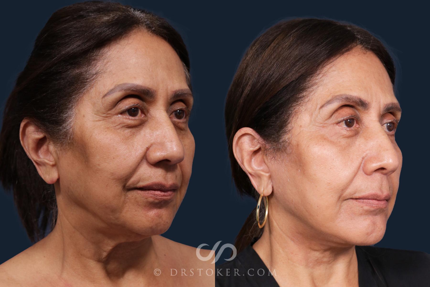 Before & After Facelift - Traceless Facelift Case 2146 Right Oblique View in Los Angeles, CA