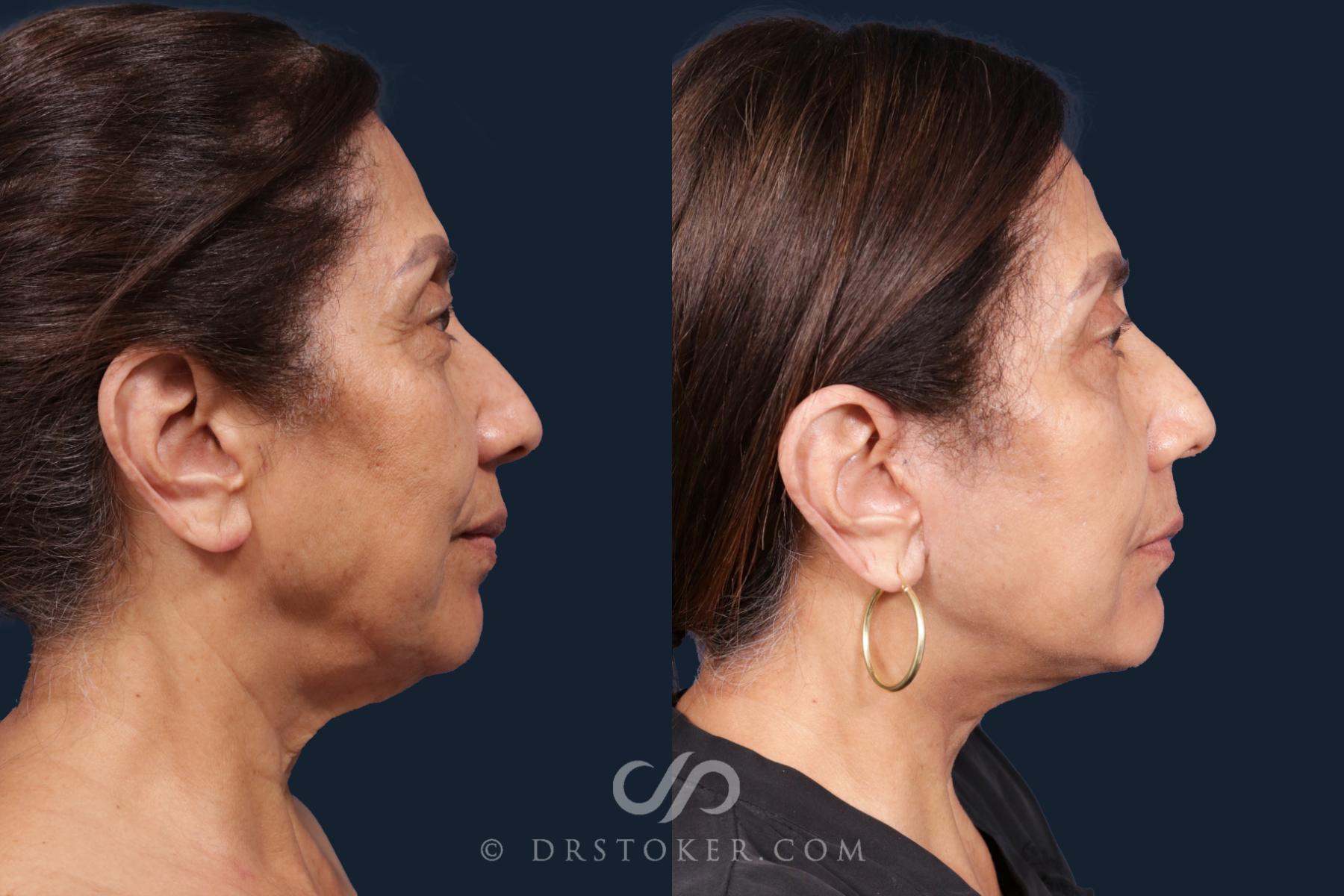 Before & After Facelift - Traceless Facelift Case 2146 Right Side View in Los Angeles, CA