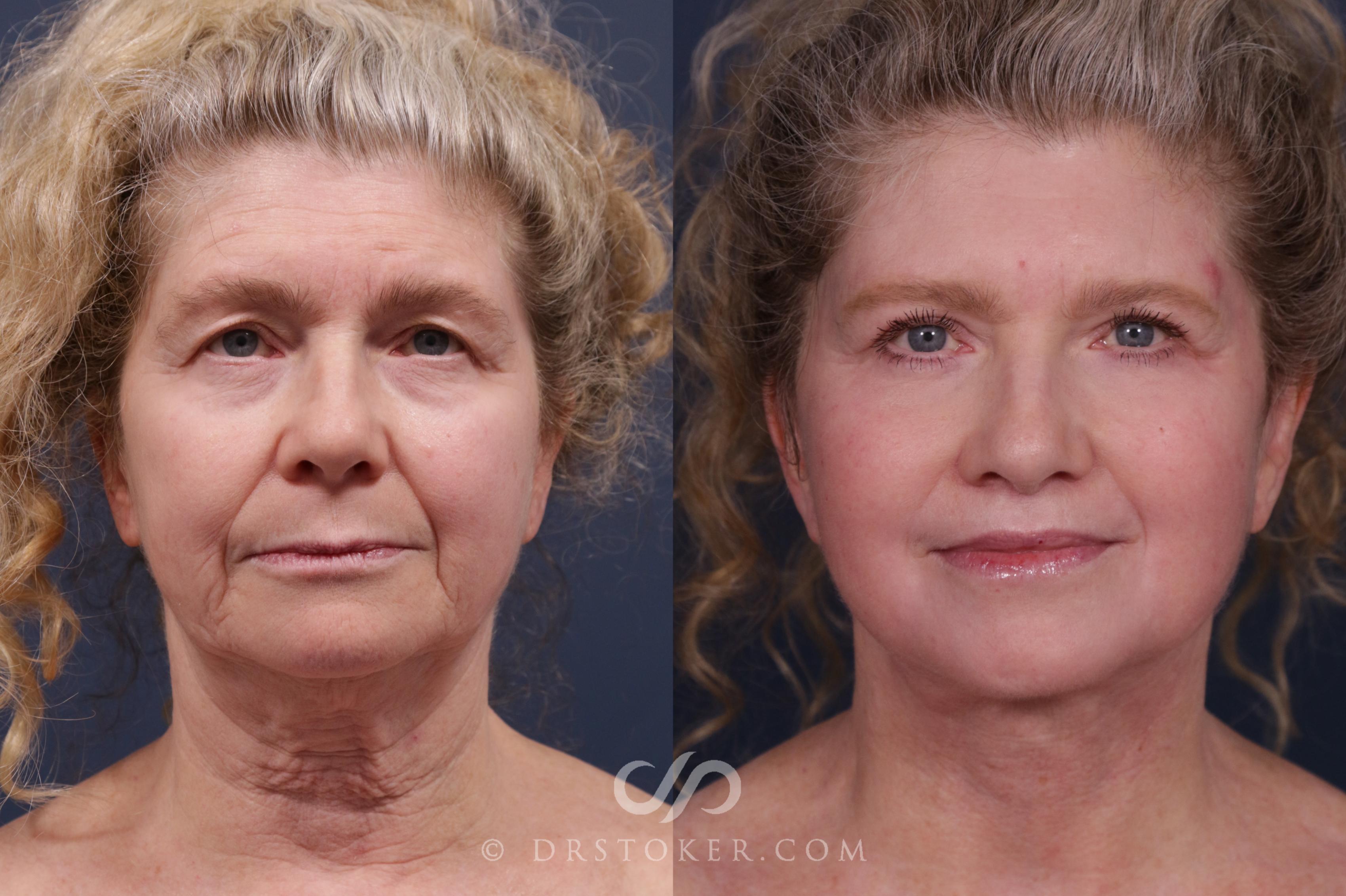 Before & After Facelift - Traceless Facelift Case 2157 Front View in Los Angeles, CA