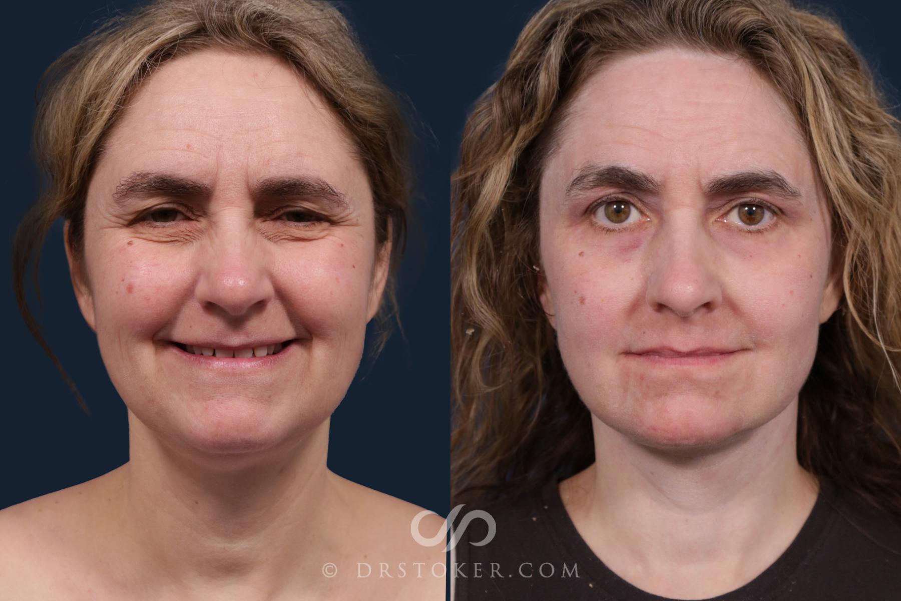 Before & After Facelift - Traceless Facelift Case 2162 Front View in Los Angeles, CA