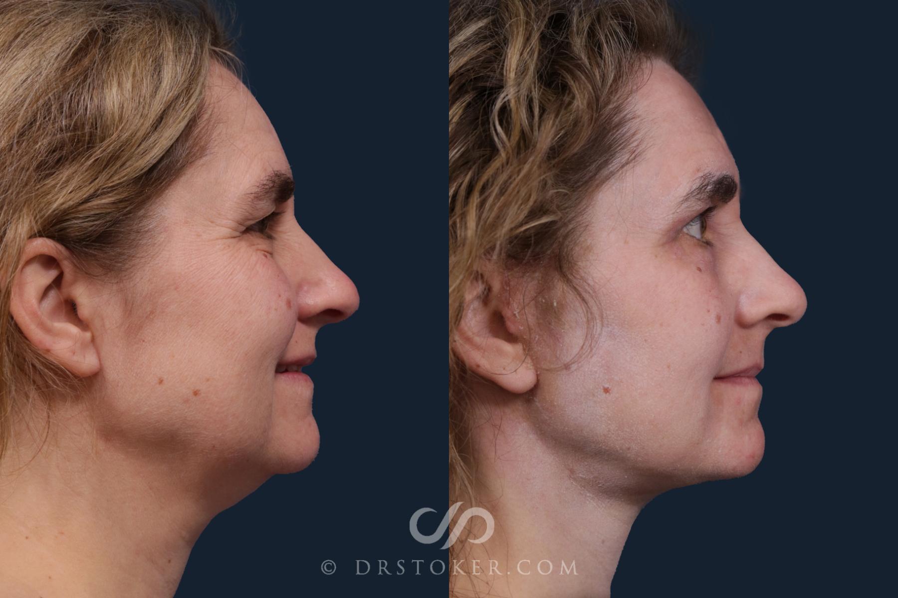 Before & After Facelift - Traceless Facelift Case 2162 Right Side View in Los Angeles, CA