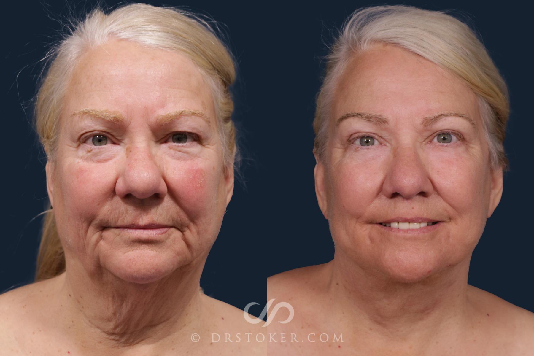 Before & After Facelift - Traceless Facelift Case 2178 Front View in Los Angeles, CA
