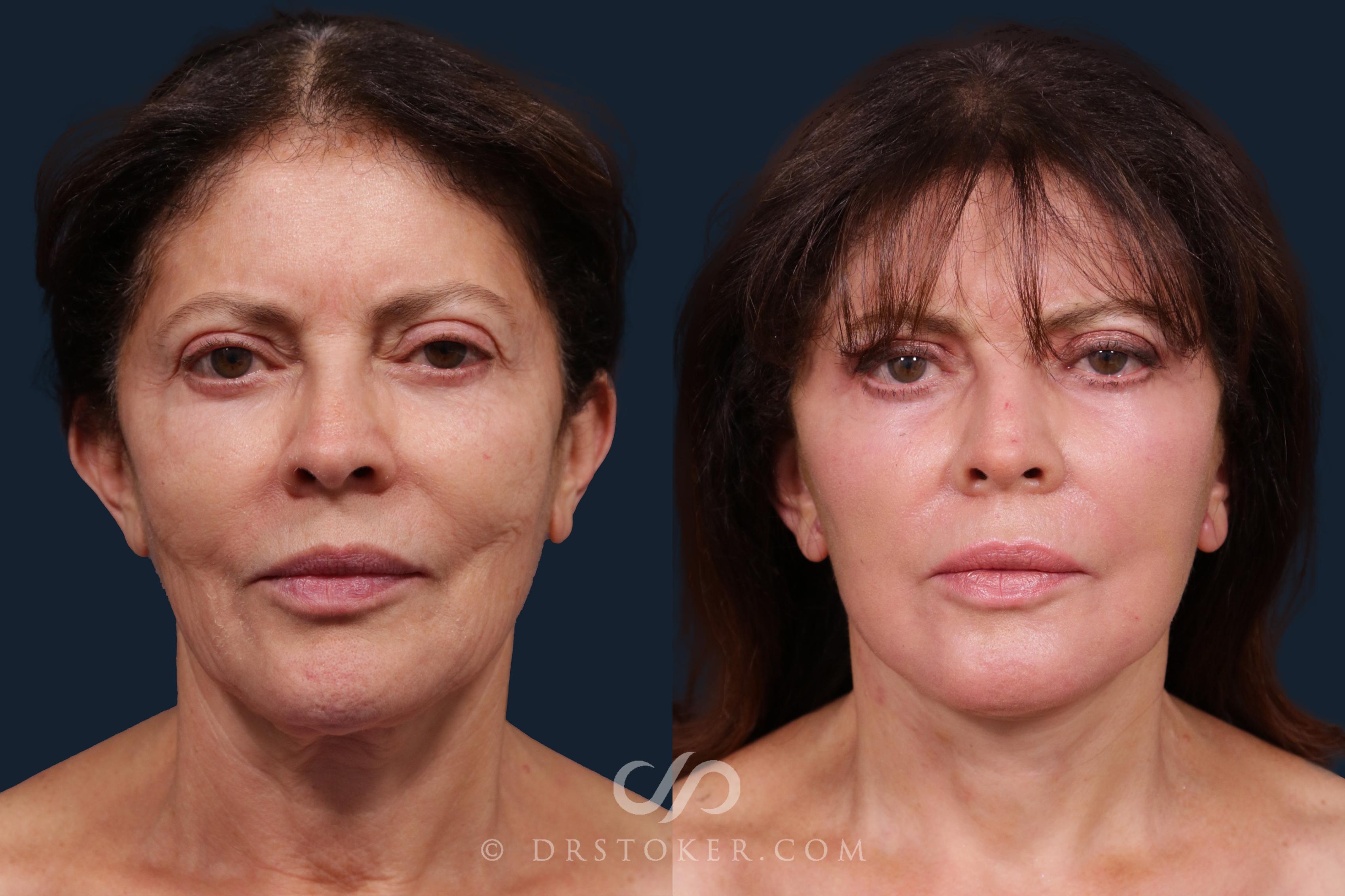 Before & After Facelift - Traceless Facelift Case 2201 Front View in Los Angeles, CA