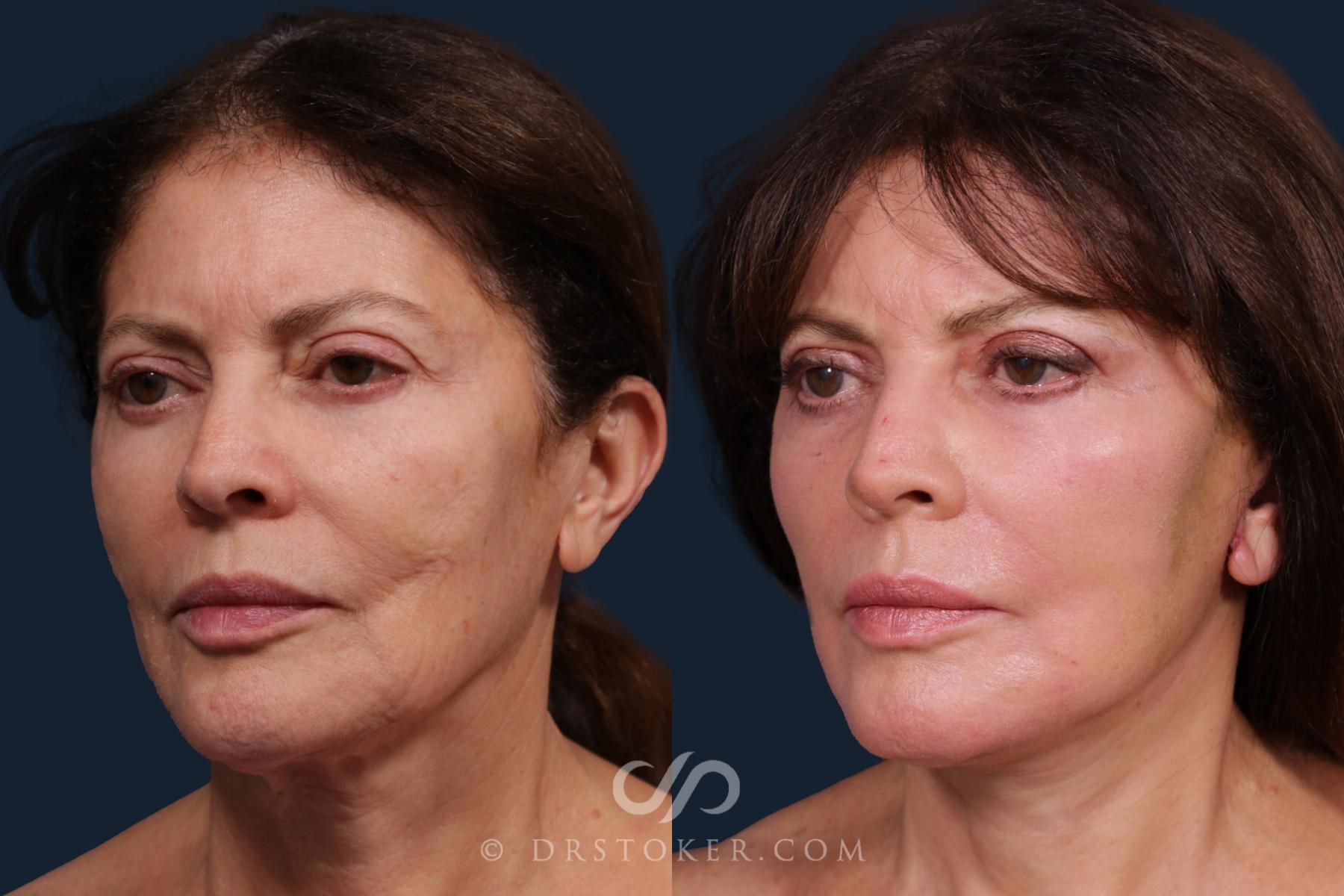 Before & After Facelift - Traceless Facelift Case 2201 Left Oblique View in Los Angeles, CA