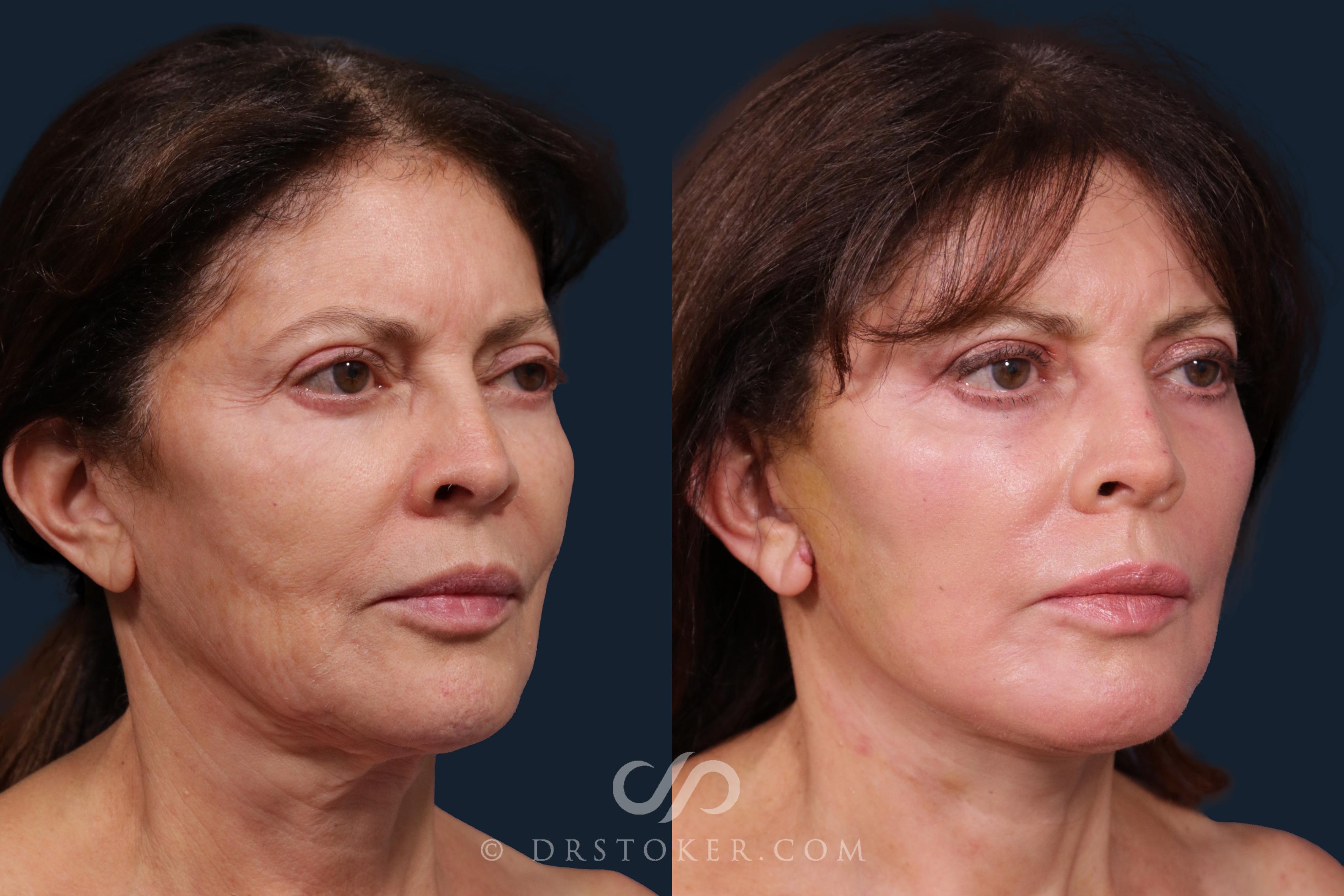 Before & After Facelift - Traceless Facelift Case 2201 Right Oblique View in Los Angeles, CA