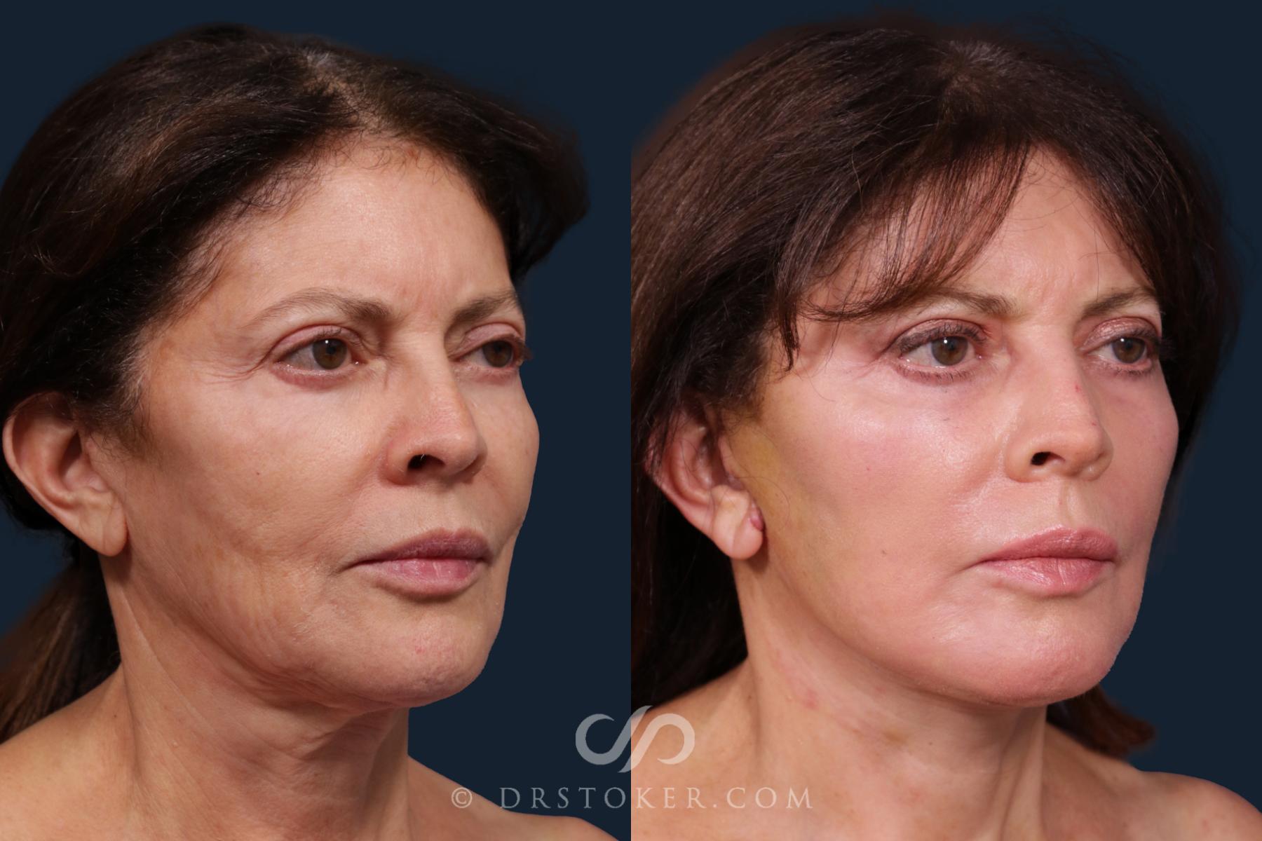 Before & After Facelift - Traceless Facelift Case 2201 Right Oblique View in Los Angeles, CA