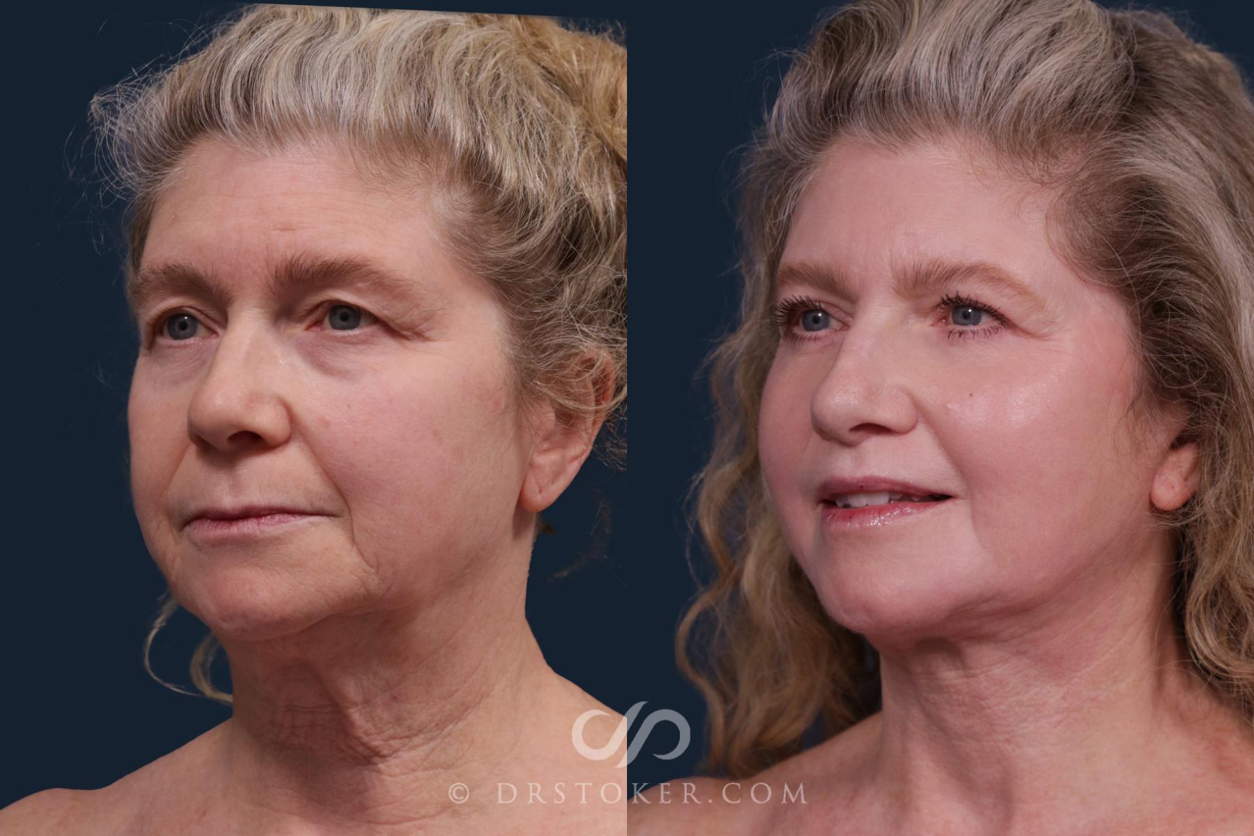 Before & After Facelift - Traceless Facelift Case 2204 Front View in Los Angeles, CA