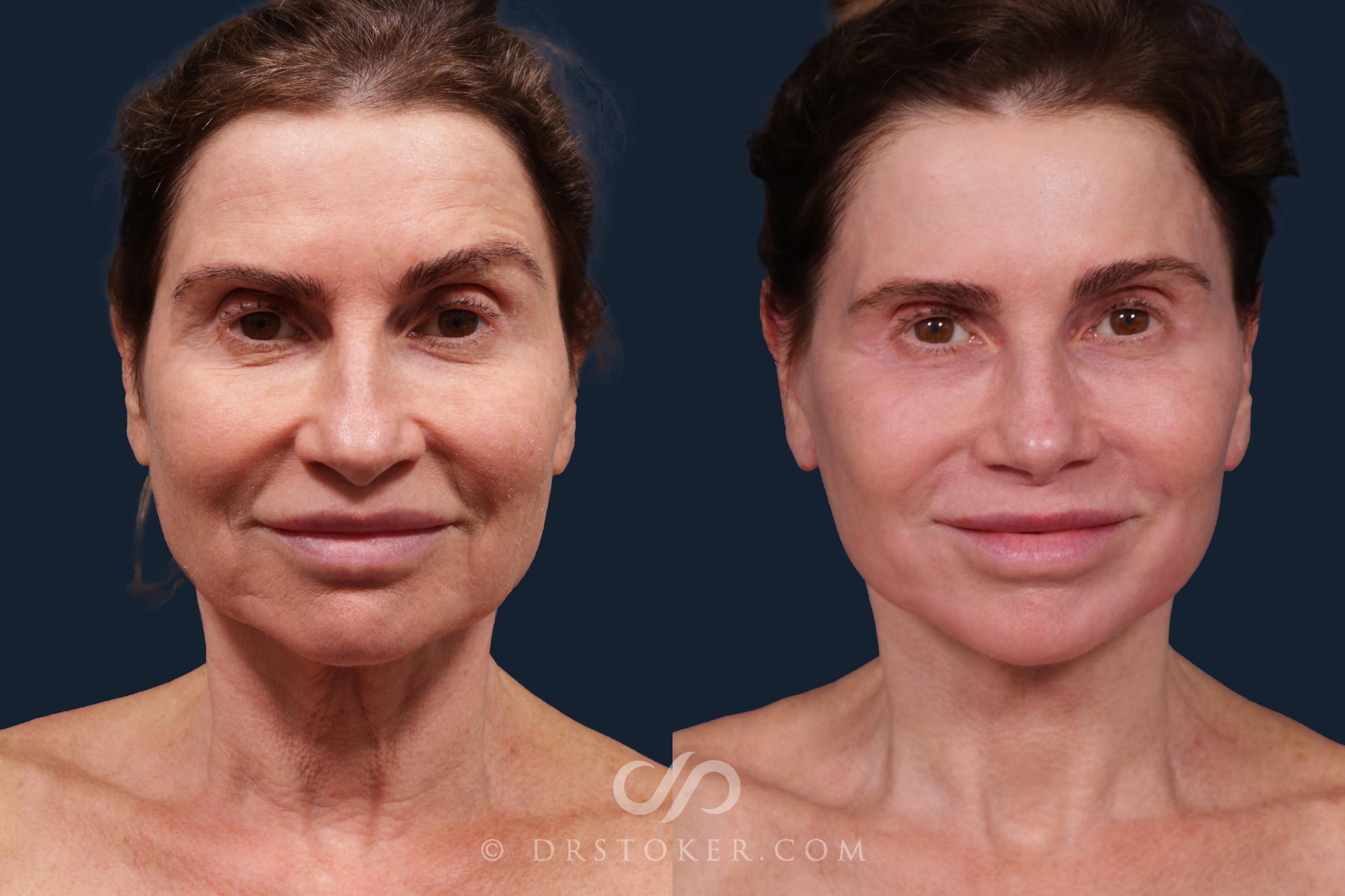 Before & After Facelift - Traceless Facelift Case 2219 Front View in Los Angeles, CA