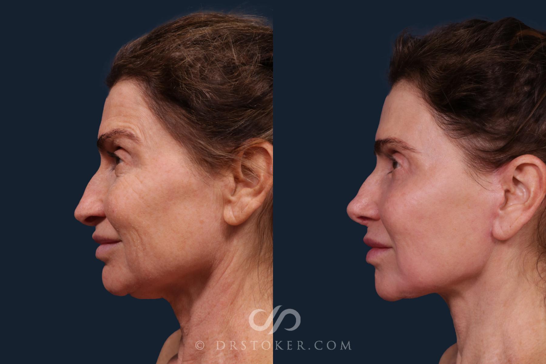 Before & After Facelift - Traceless Facelift Case 2219 Left Side View in Los Angeles, CA
