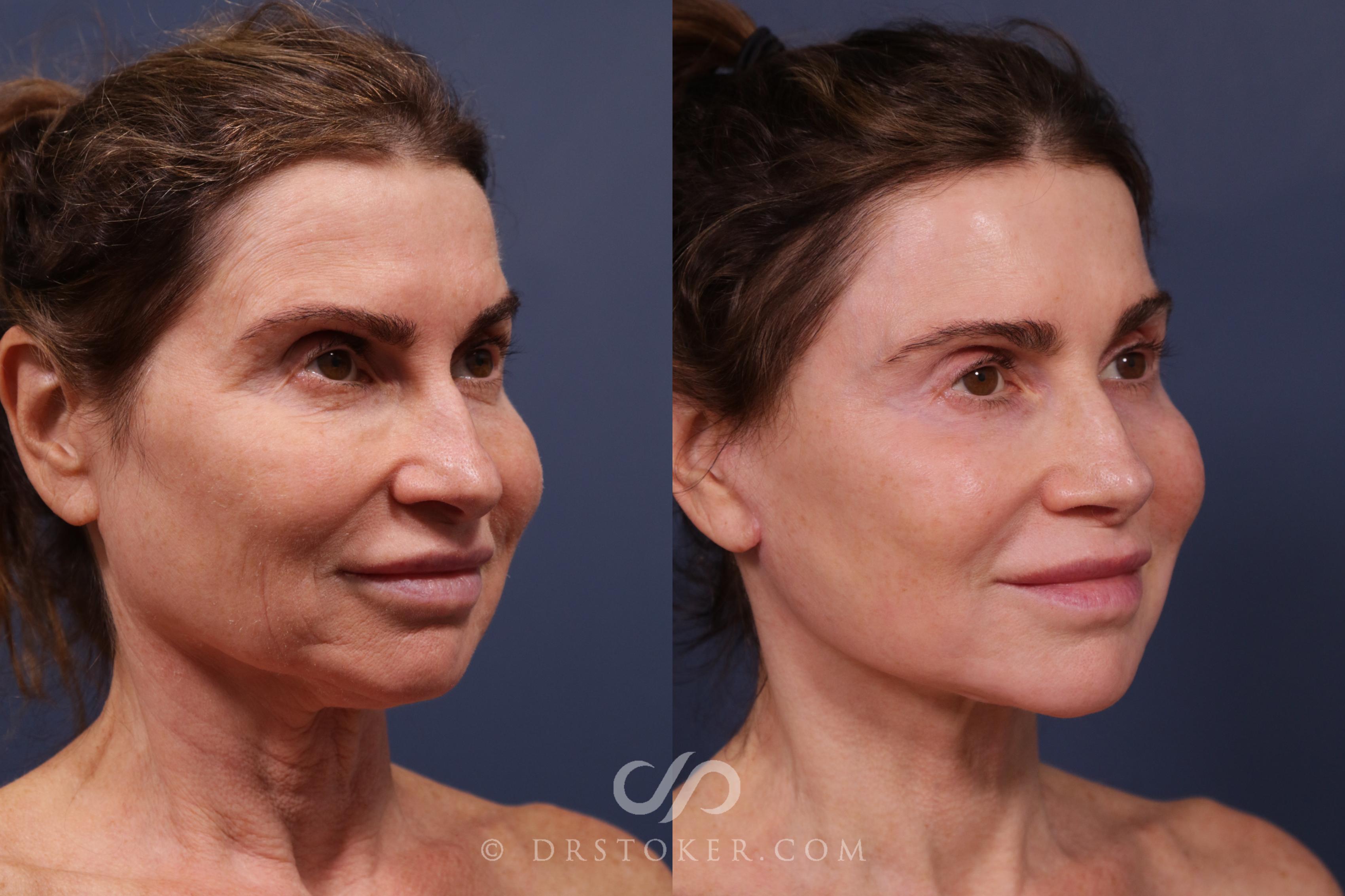 Before & After Facelift - Traceless Facelift Case 2219 Right Oblique View in Los Angeles, CA