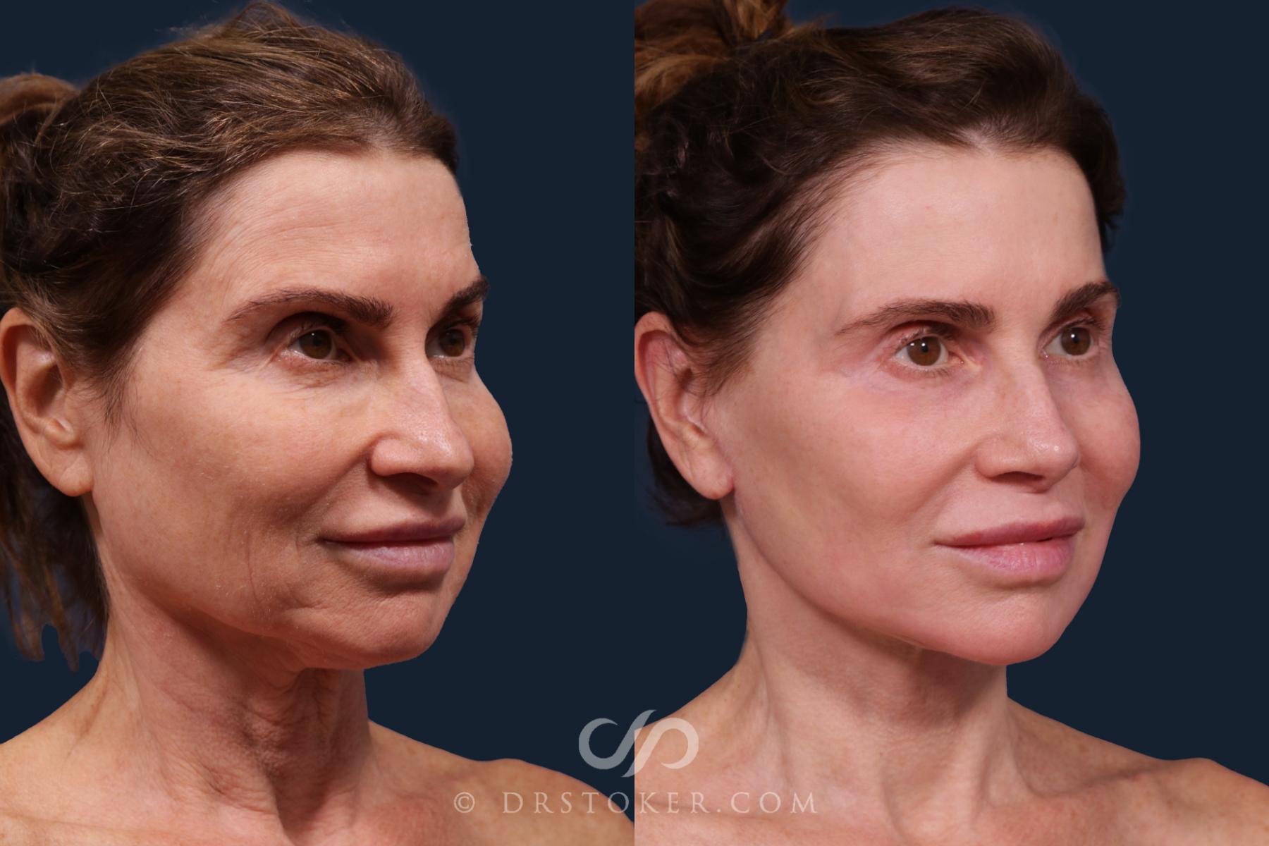 Before & After Facelift - Traceless Facelift Case 2219 Right Oblique View in Los Angeles, CA