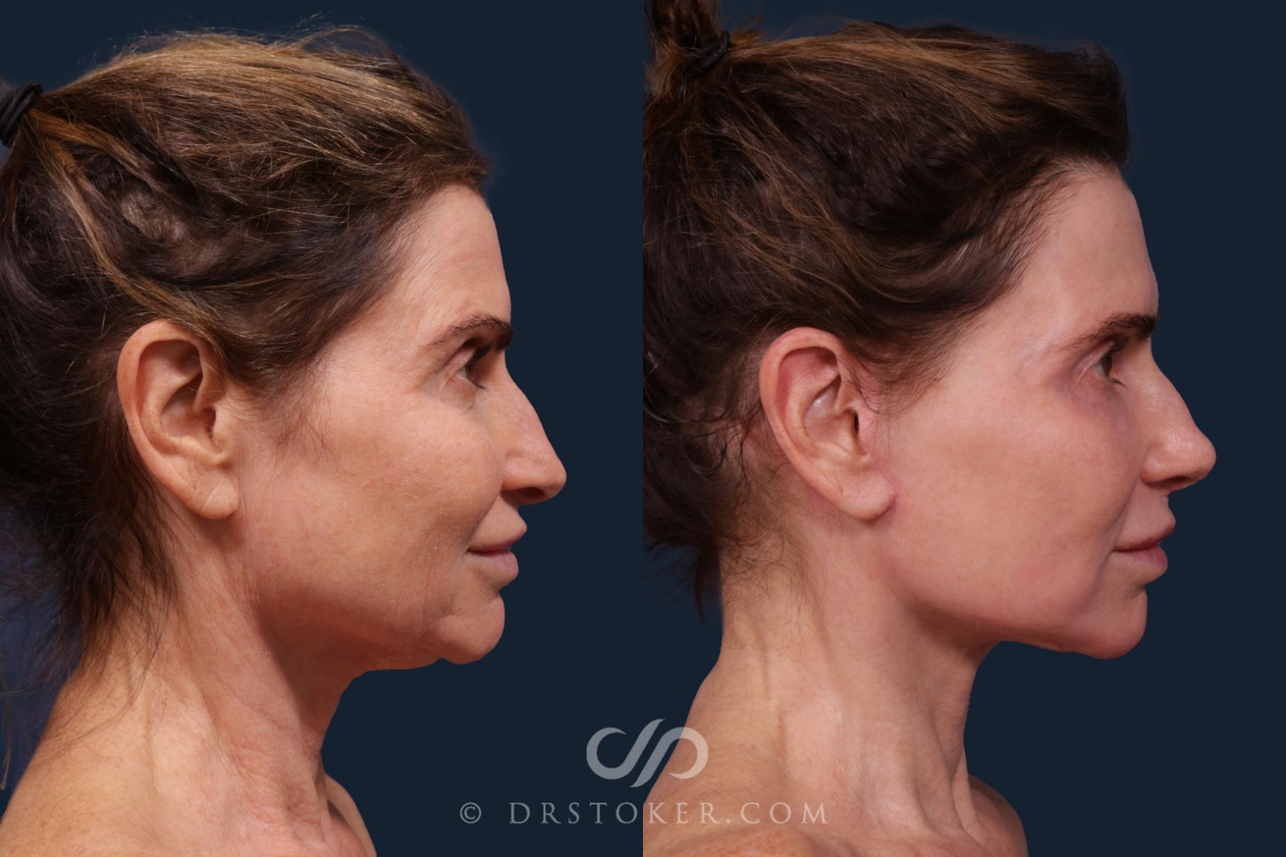 Before & After Facelift - Traceless Facelift Case 2219 Right Side View in Los Angeles, CA
