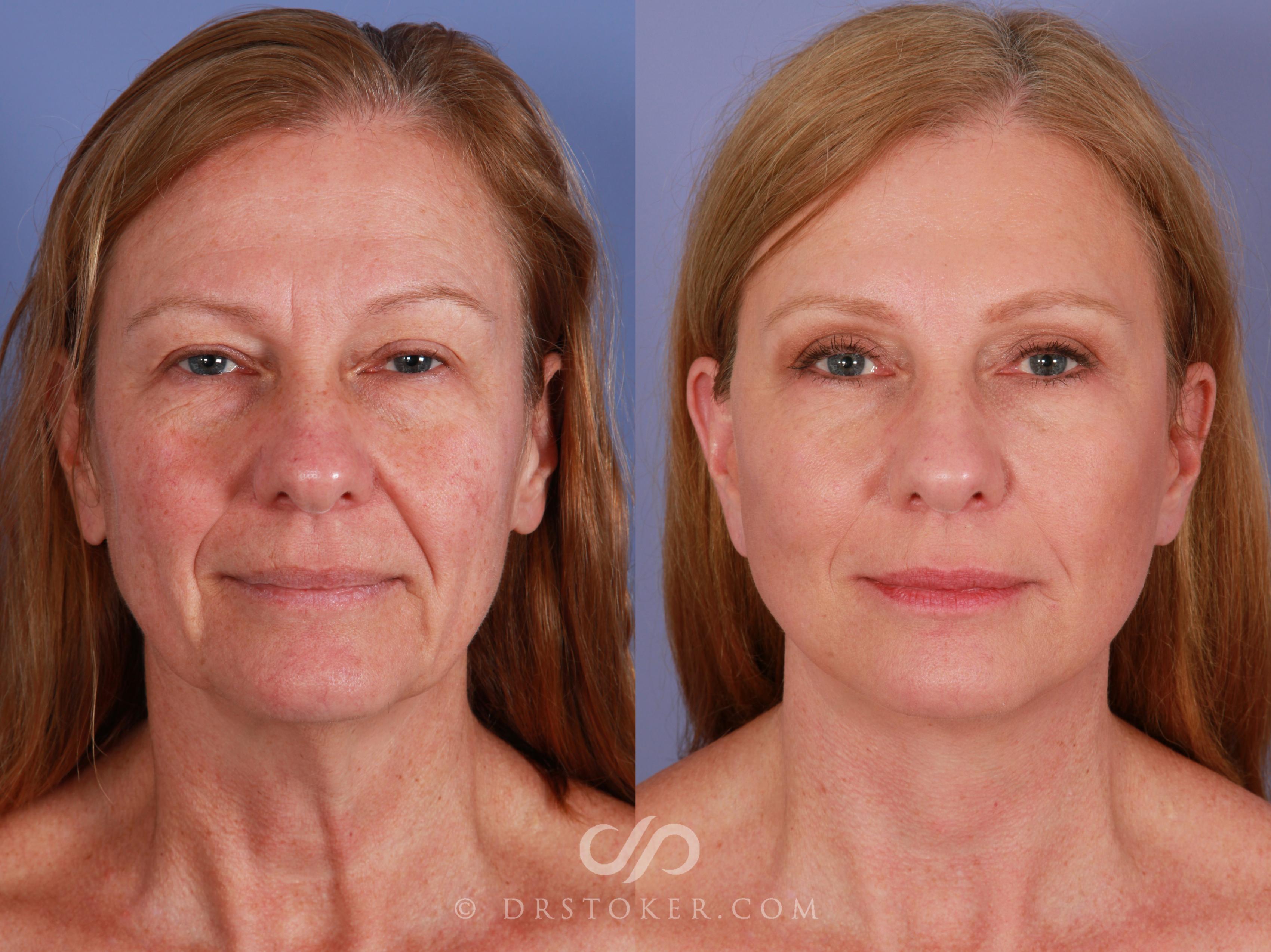 Before & After Facelift - Traceless Facelift Case 2299 Front View in Los Angeles, CA