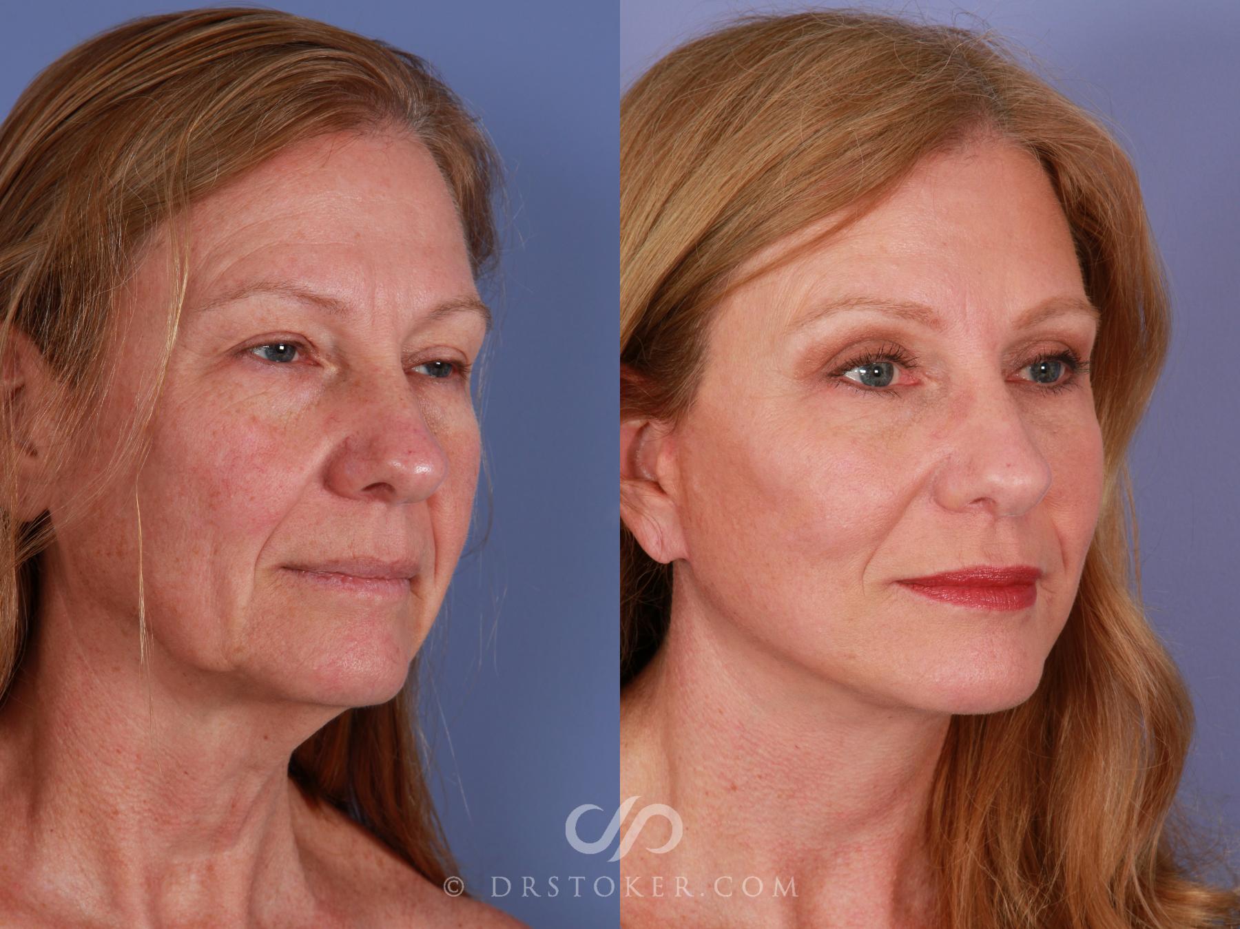 Before & After Facelift - Traceless Facelift Case 2299 Right Oblique View in Los Angeles, CA